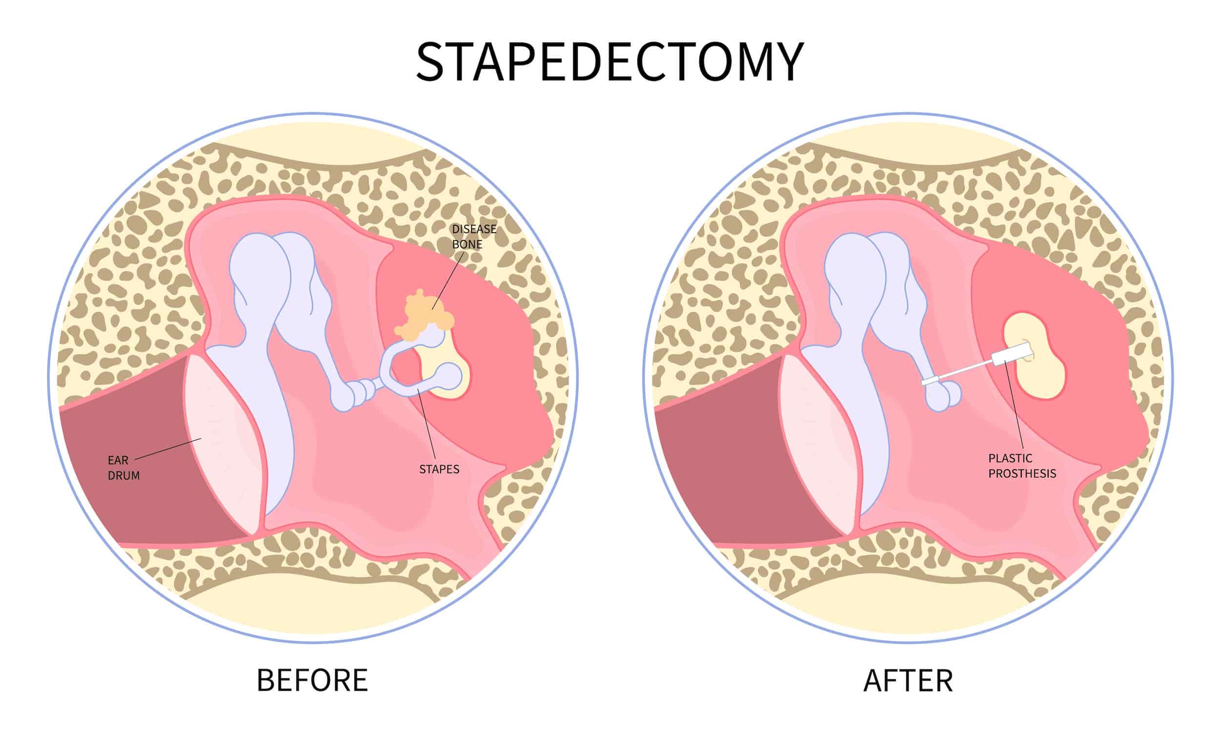 Turkiye laser stapedotomy surgery