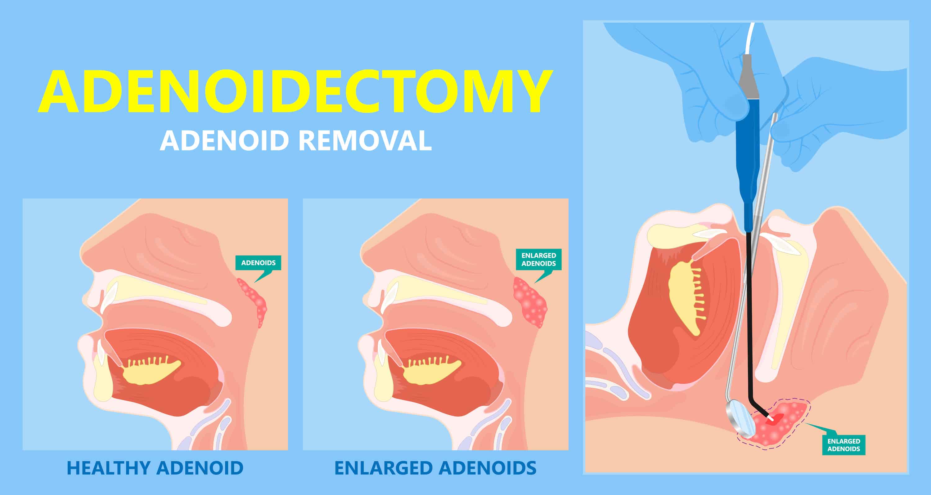Turkiye adenoidectomy