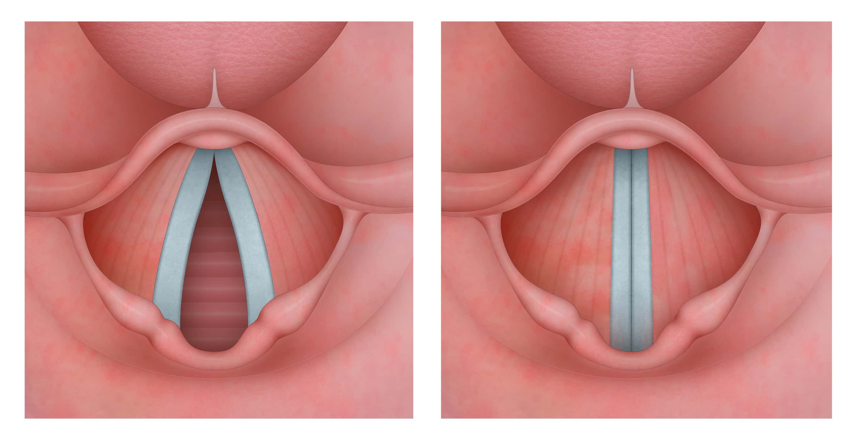 Procdure de traitement laryngologique turquie
