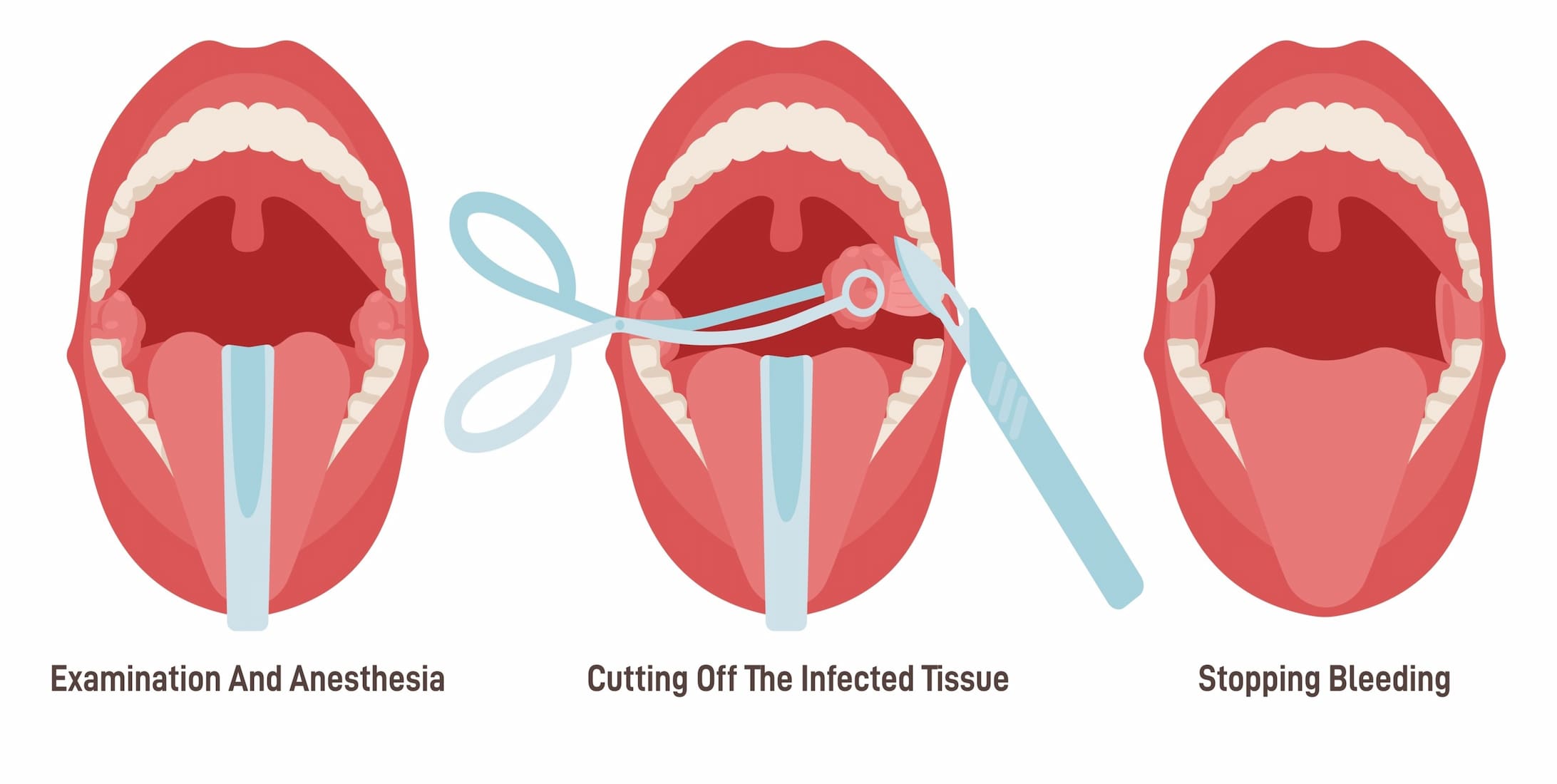 Turkiye tonsillectomy