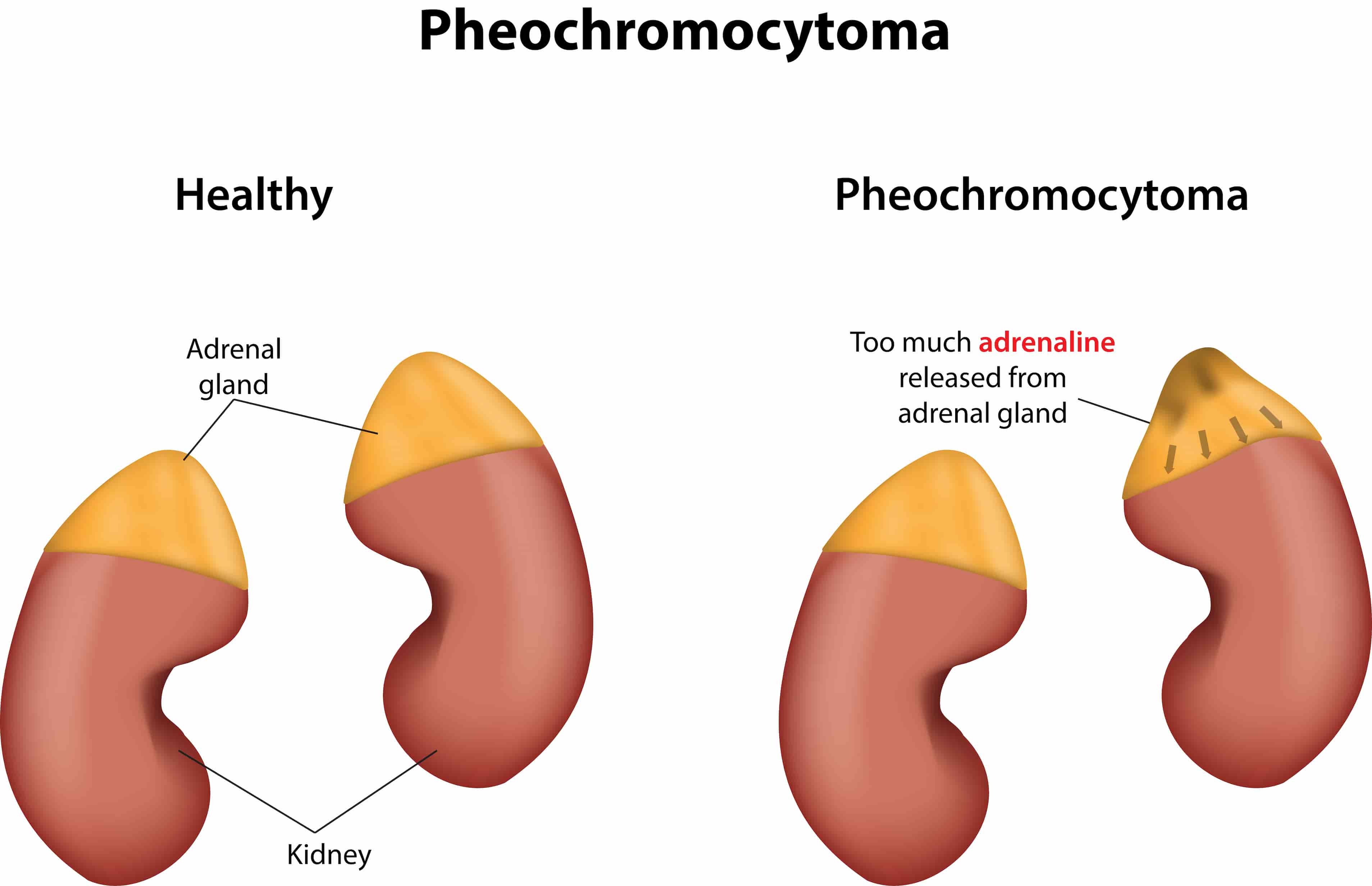 Pheochromocytoma treatment turkiye