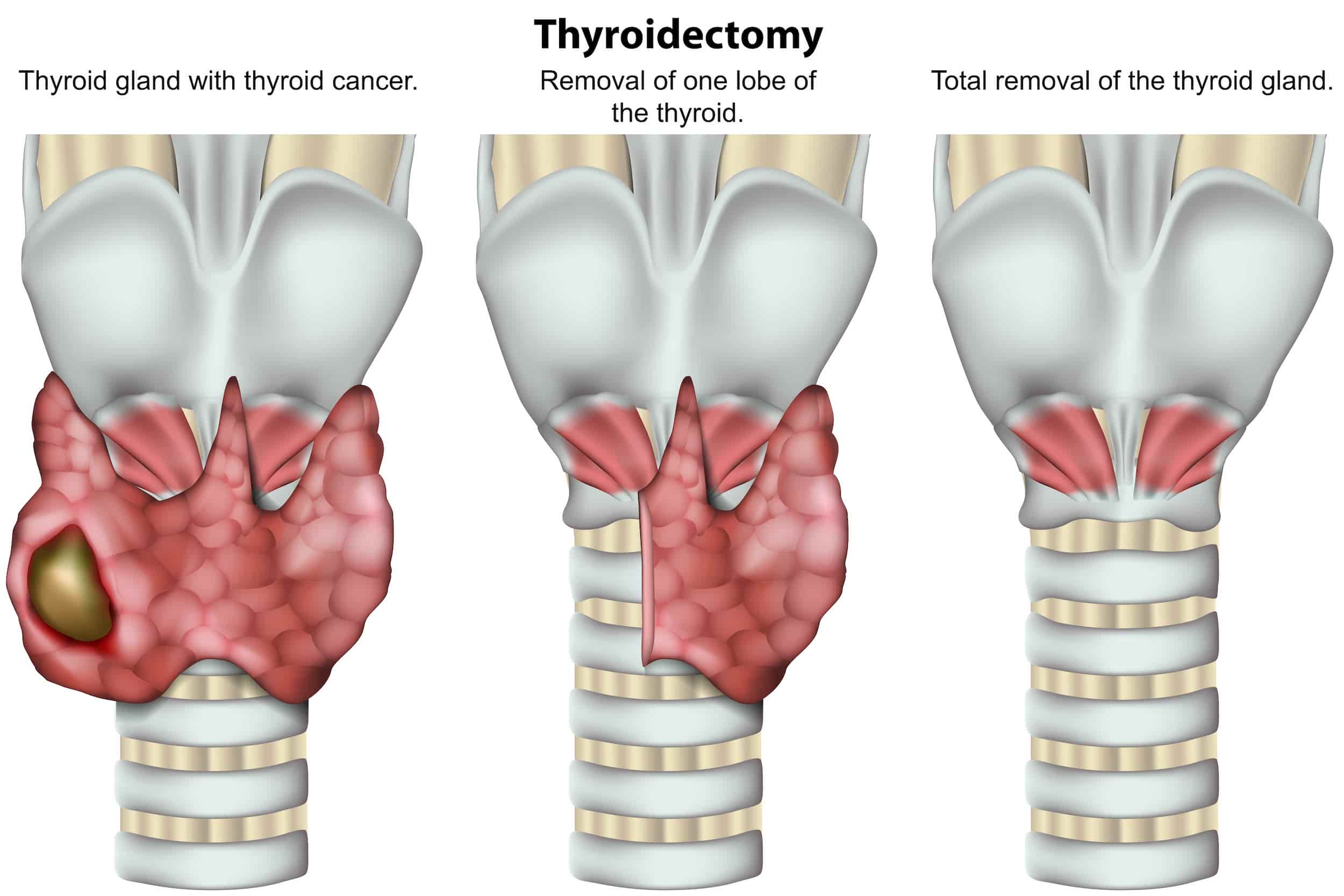 Turkiye thyroidectomy