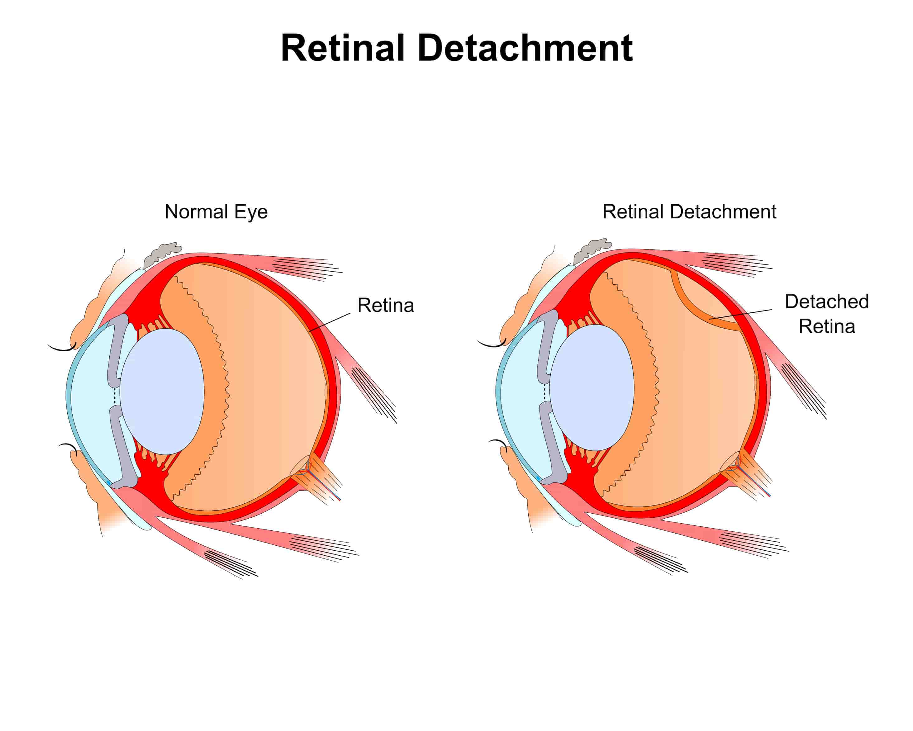 Turkiye retinal detachment treatment