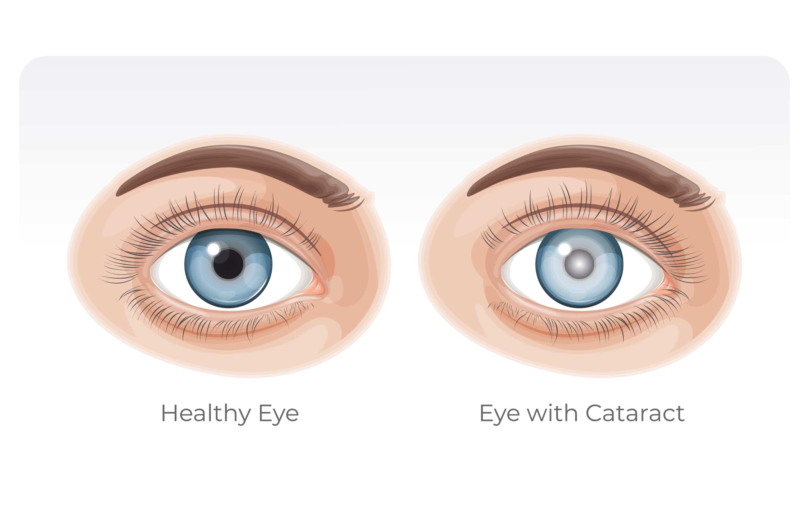 Cataract surgery turkiye