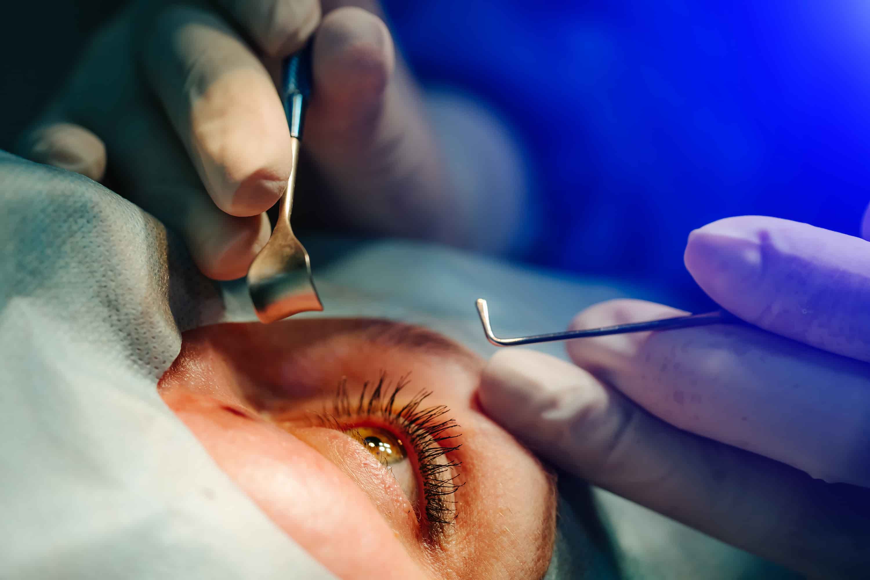 Turkiye cataract surgery