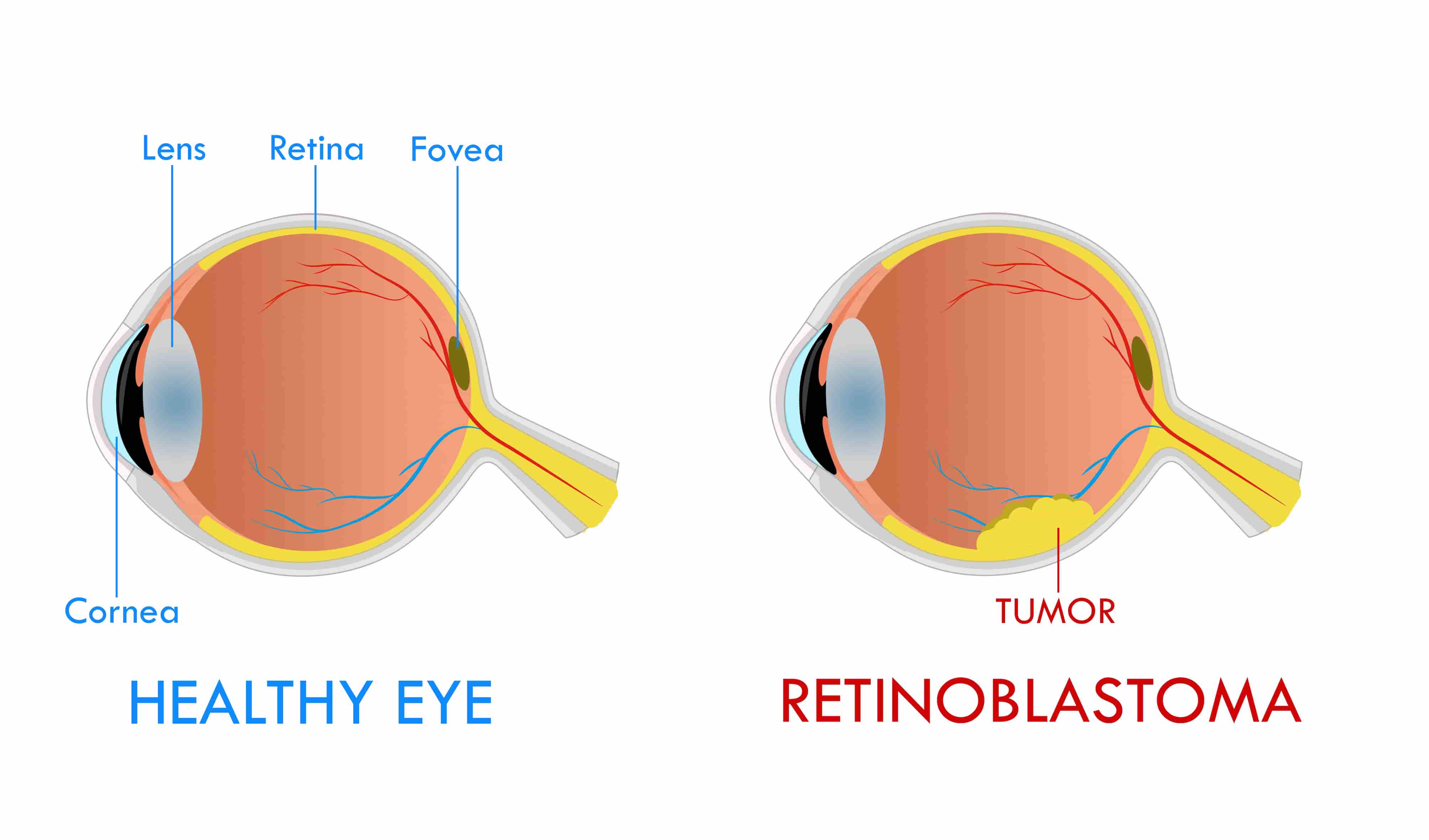 Turkiye retinoblastoma treatment