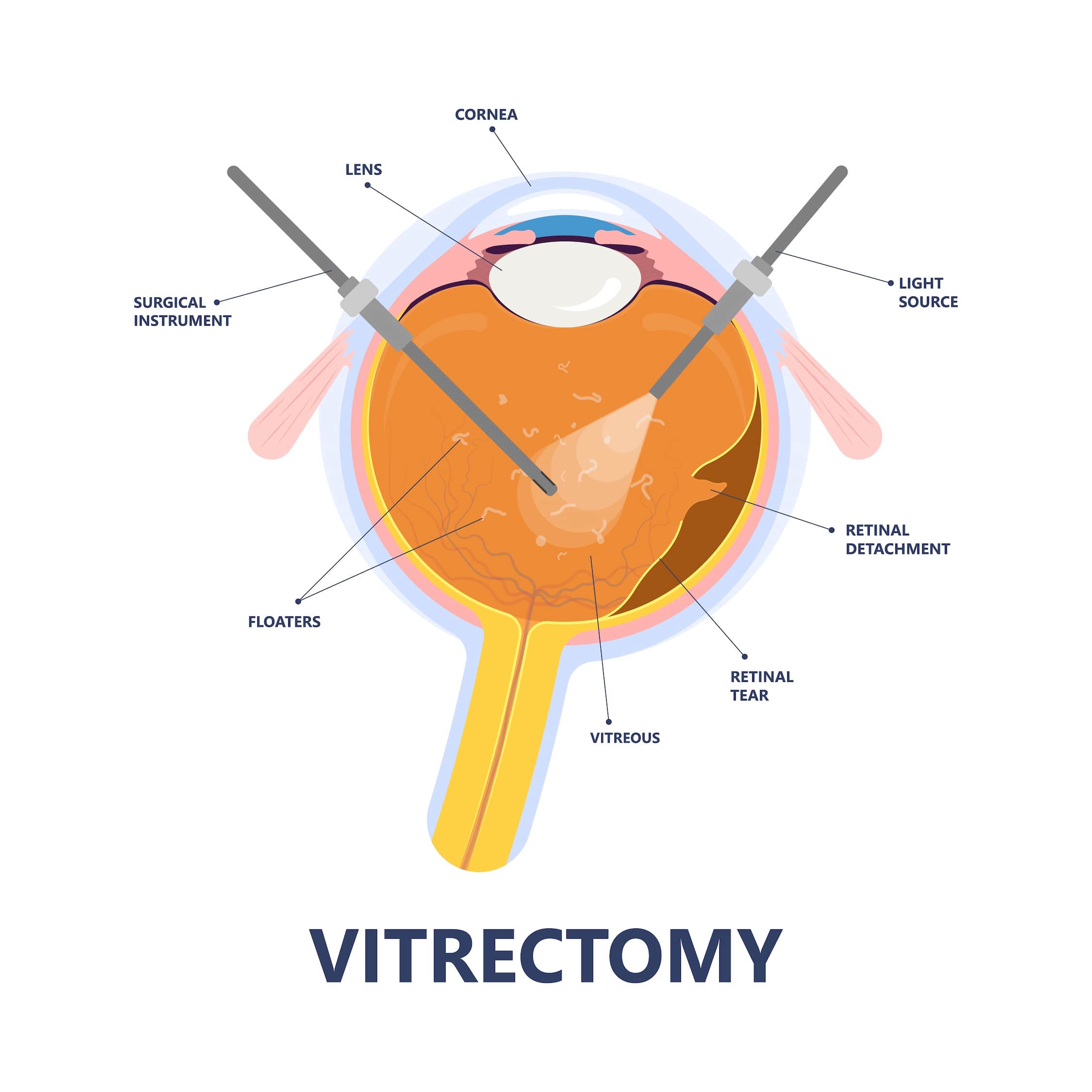 Vitrectomie turque