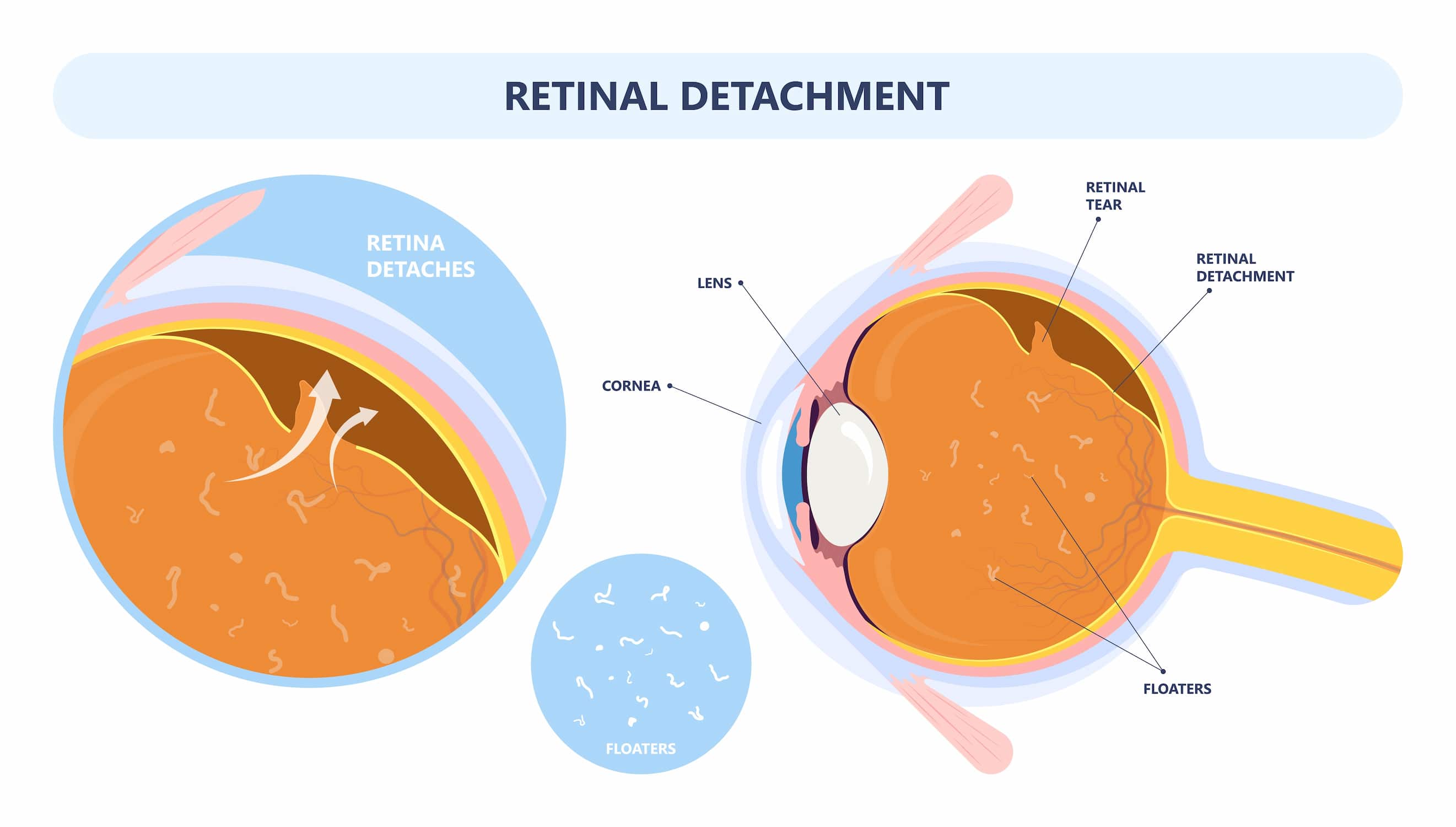 Turkiye pneumatic retinopexy surgery