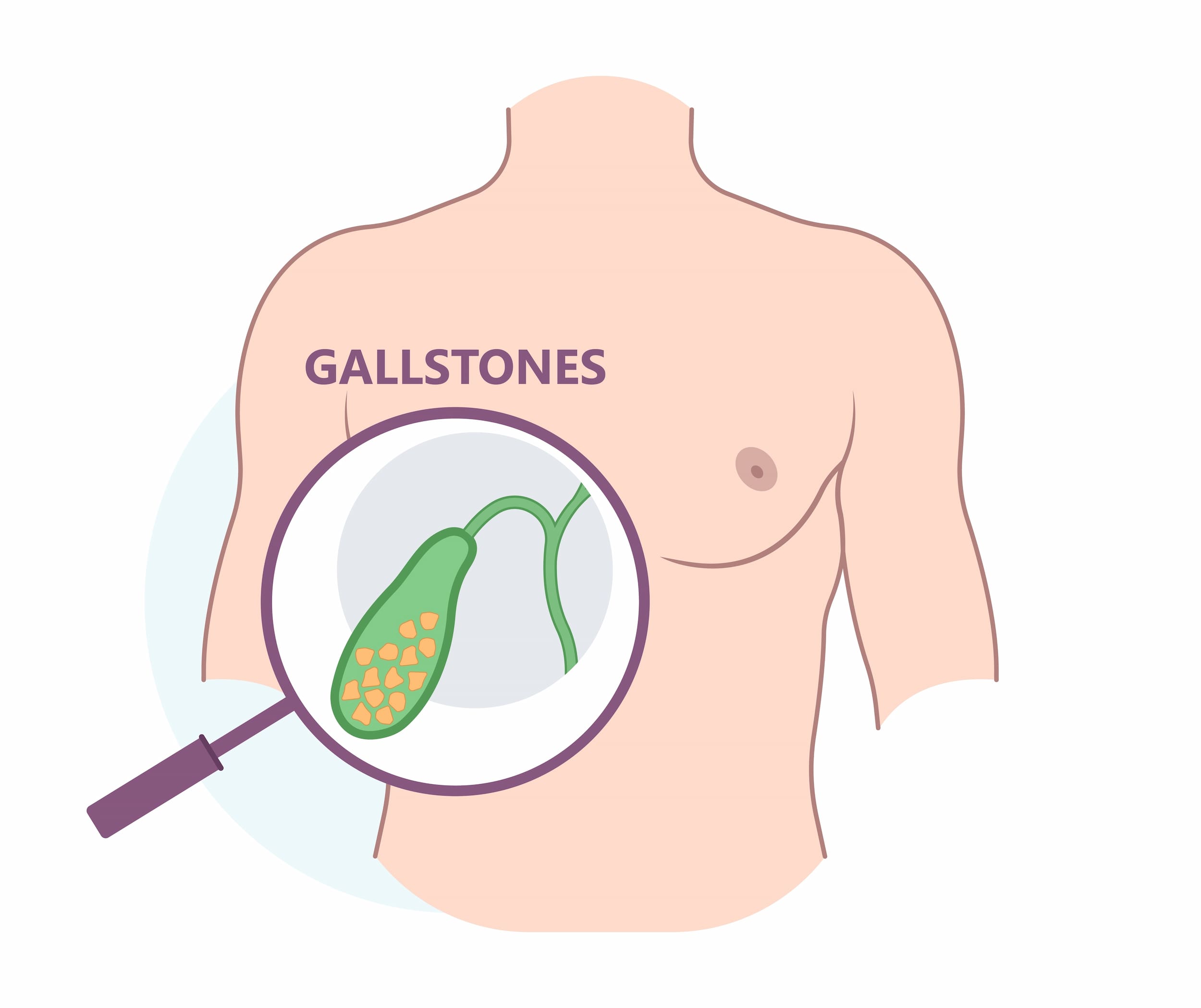 Gallbladder stone removal surgery turkiye