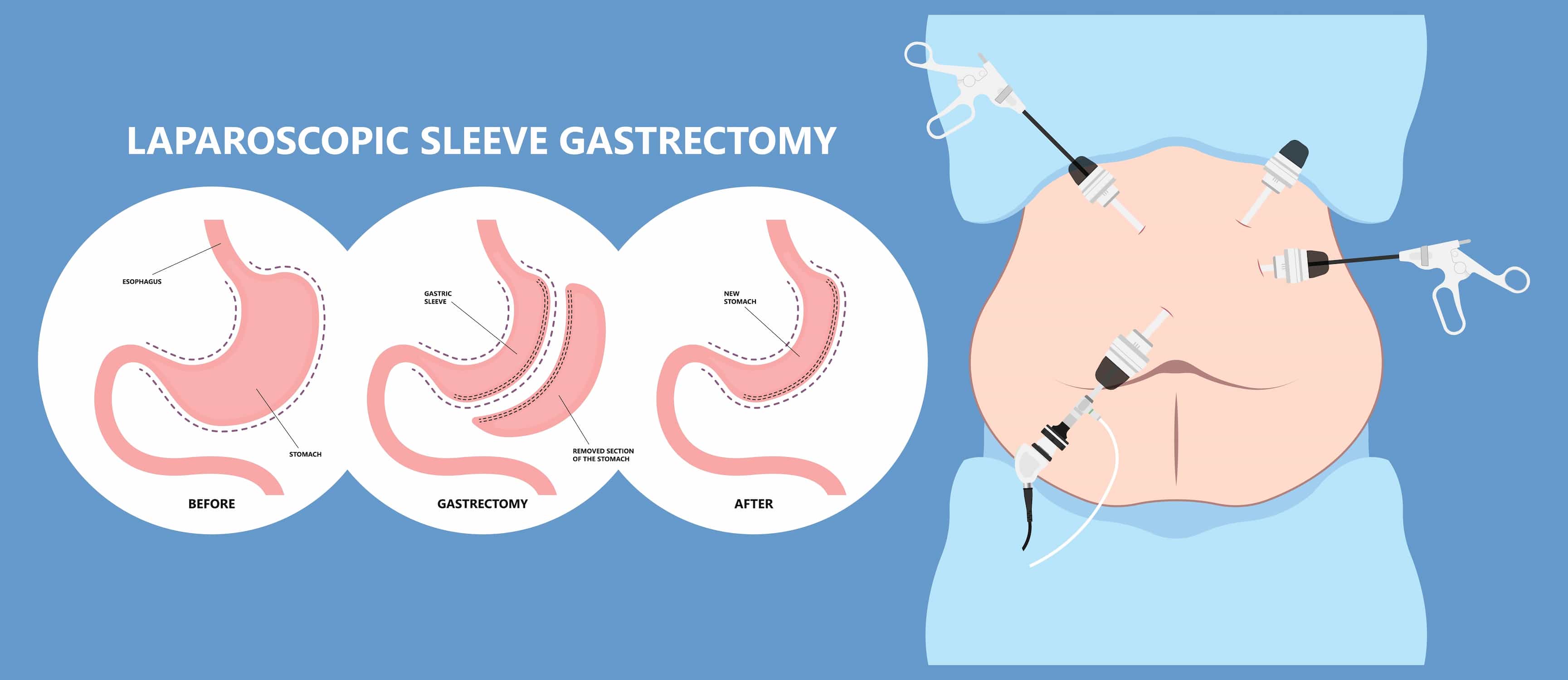 Gastrectomie laparoscopique en manchon à turquie