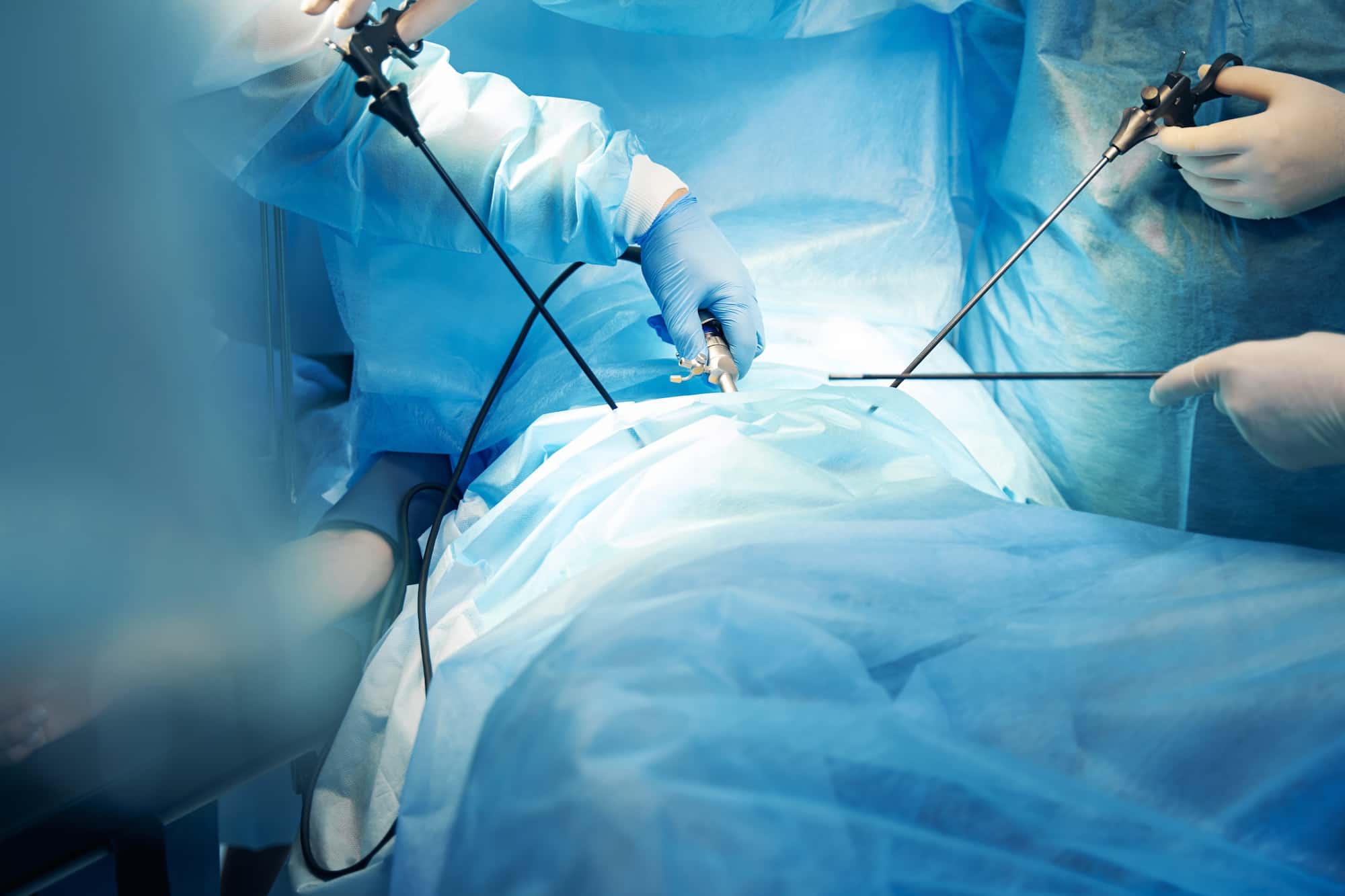 Procédure de gastrectomie laparoscopique en manchon turquie