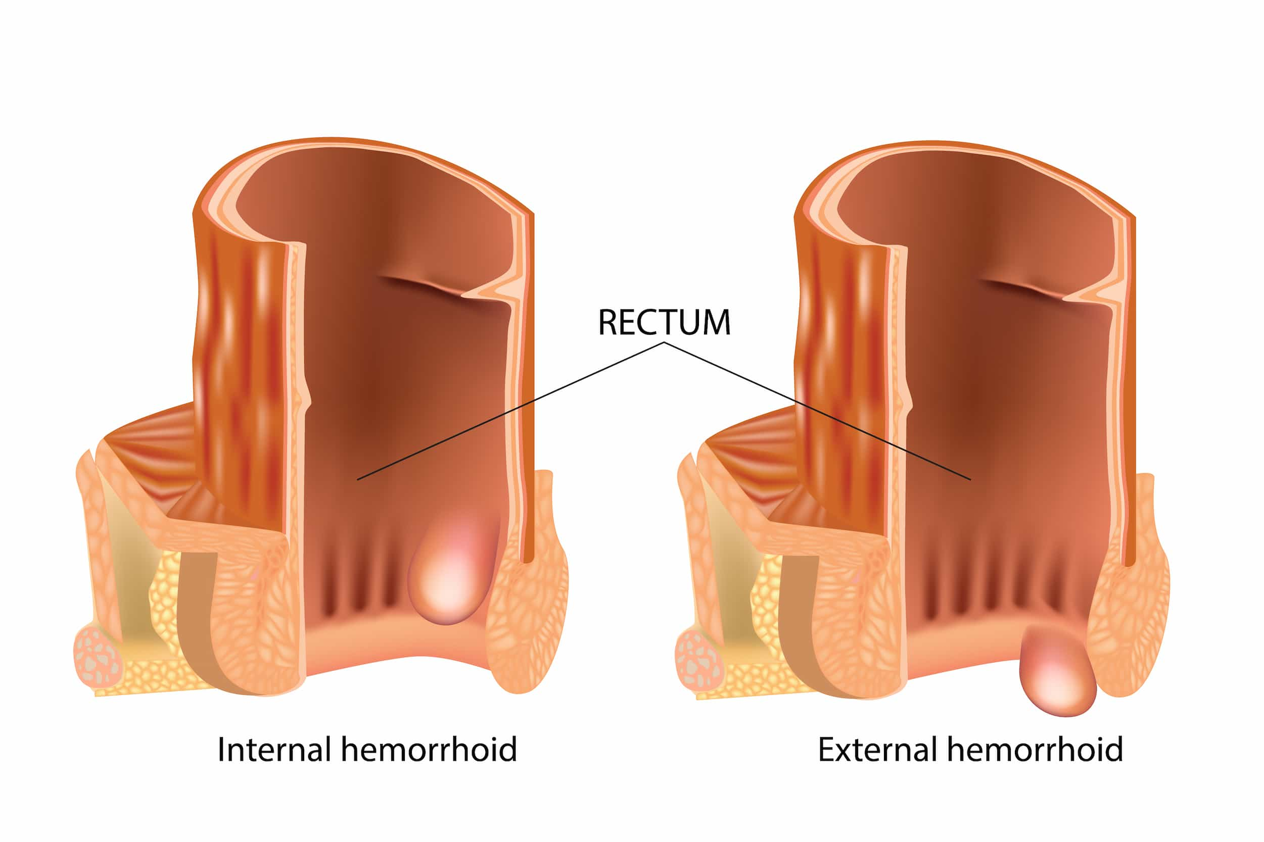 Turkiye hemorrhoid treatment