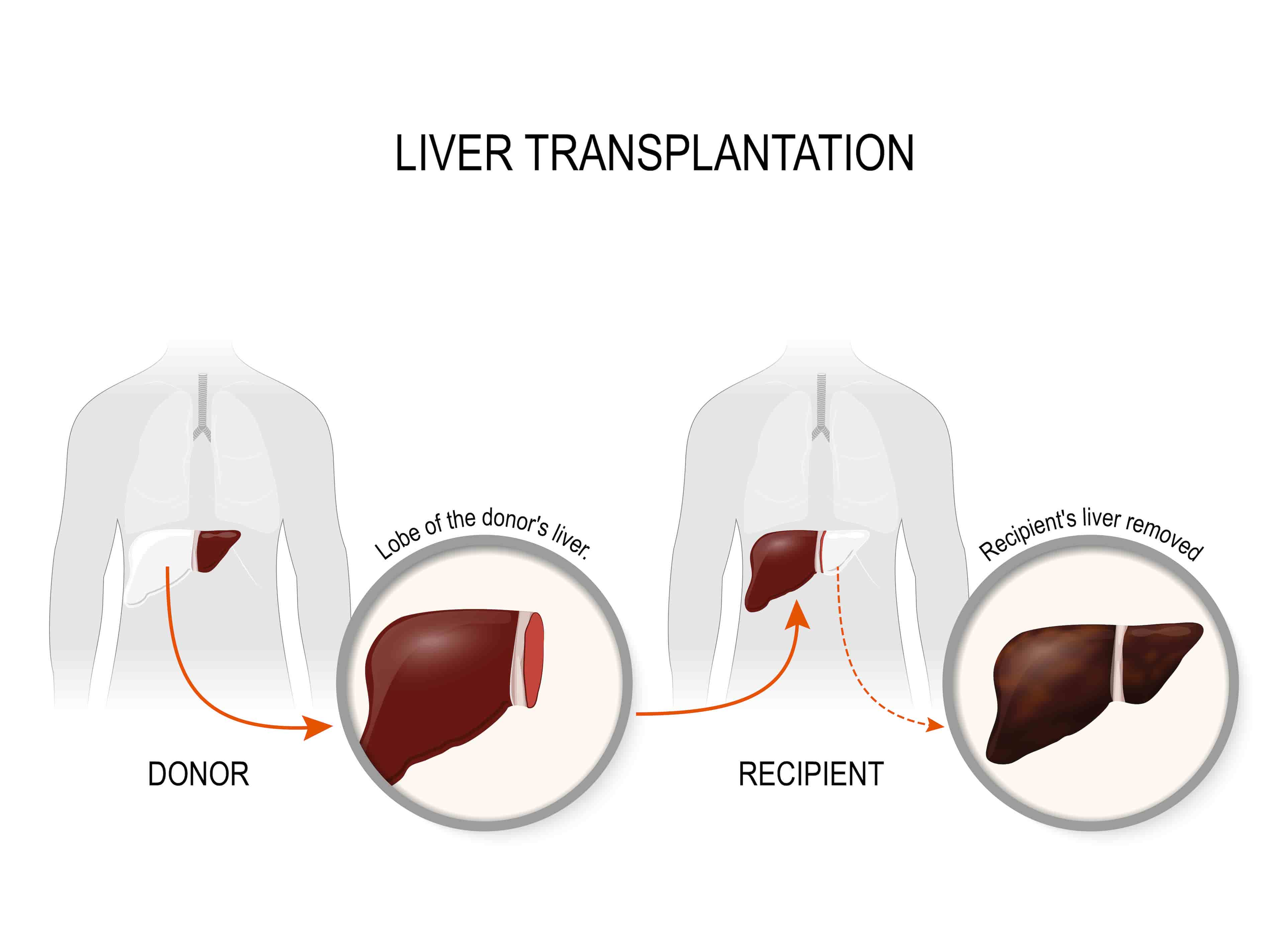Turkey liver transplant