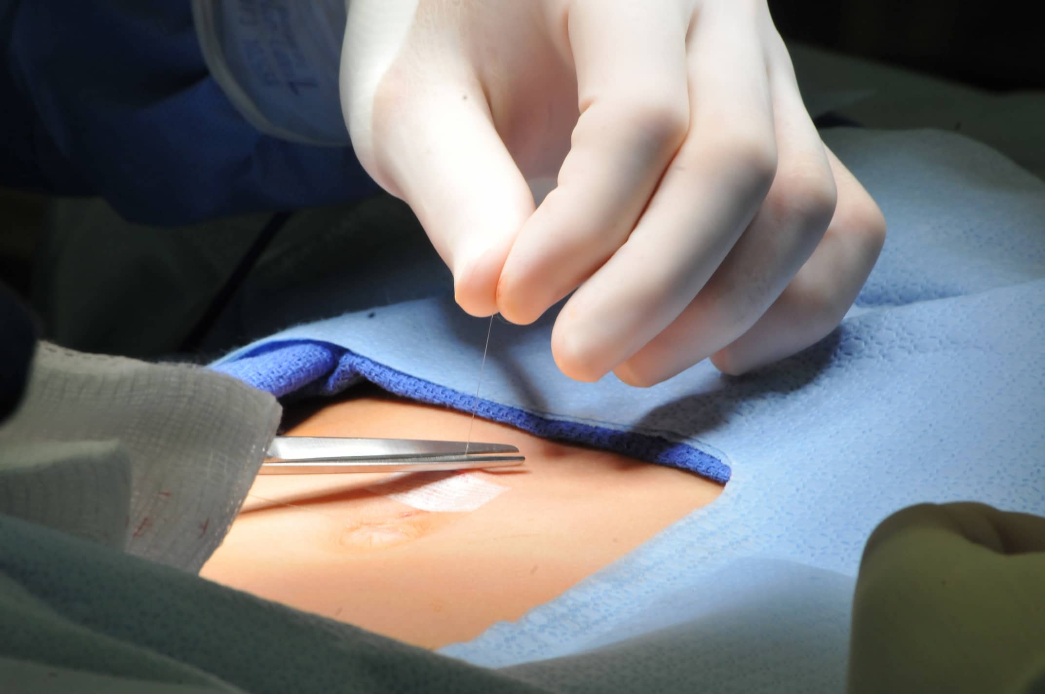 Turkiye hernia repair surgery