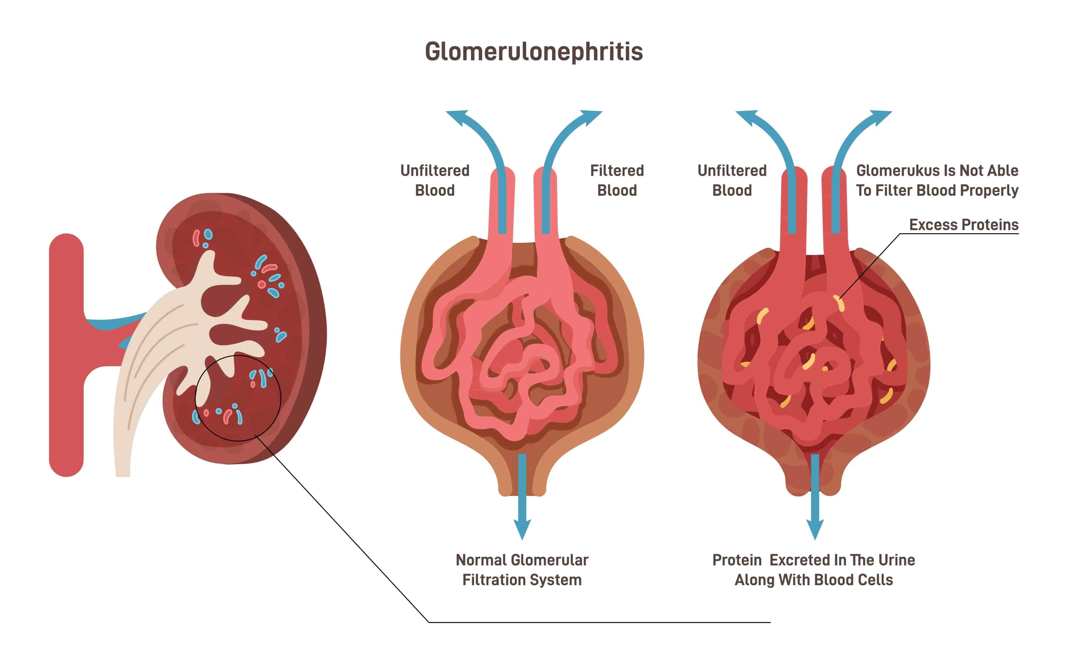 Treatment of glomerular diseases turkiye