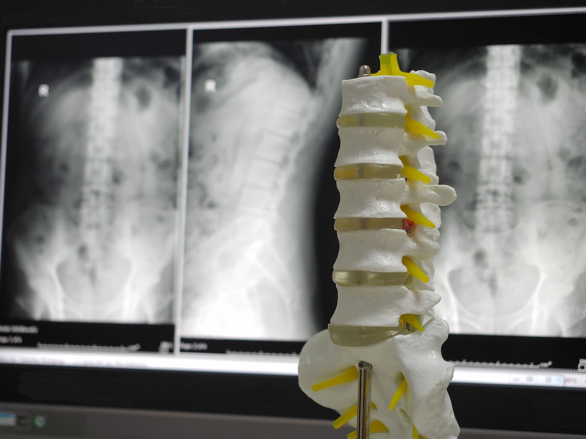 Spinal fusion surgery turkiye