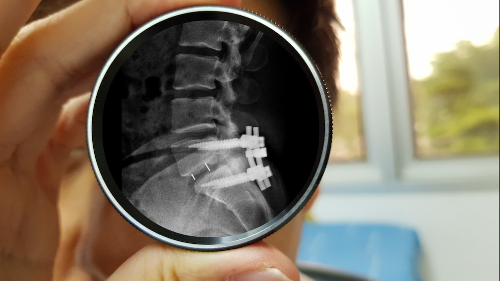 Turkiye spinal fusion surgery