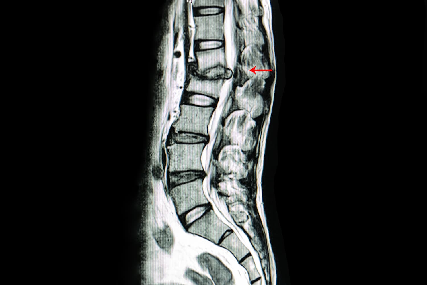 Tratamiento de estenosis espinal en turqua
