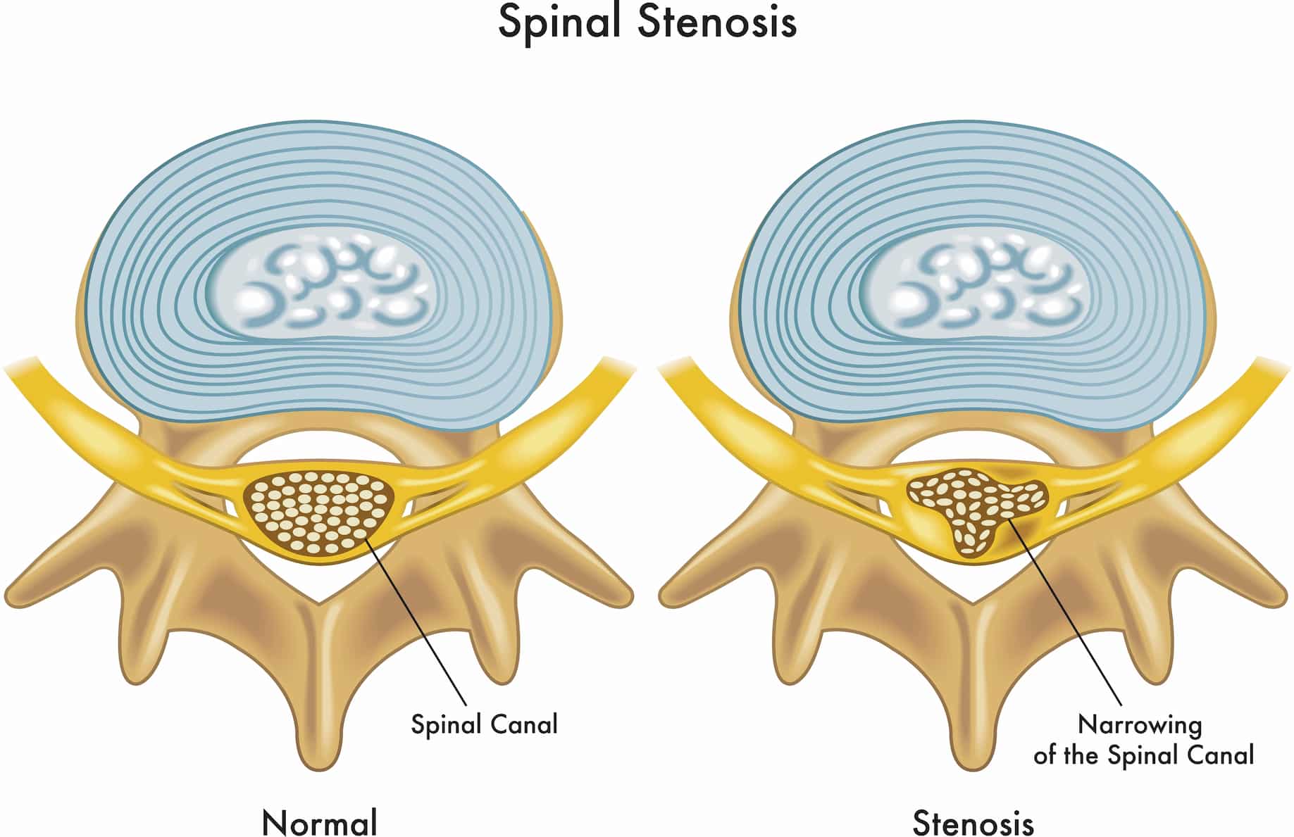 Tratamiento de estenosis espinal turqua