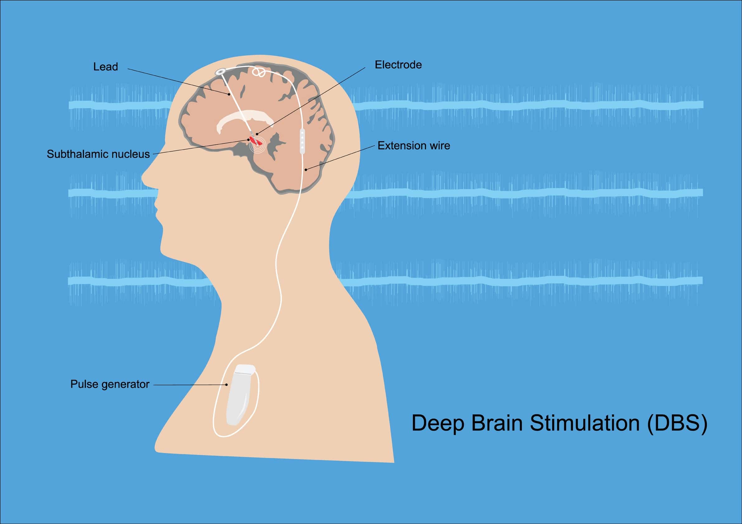 Turkiye deep brain stimulation