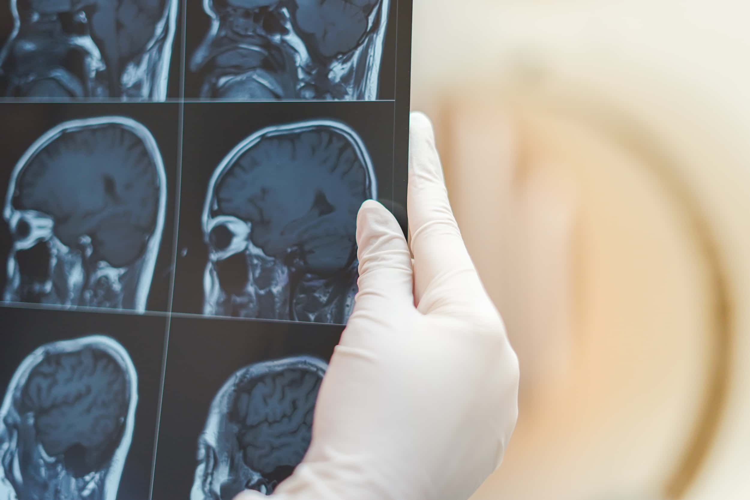 Craniotomie pour résection d'une tumeur cérébrale en turquie