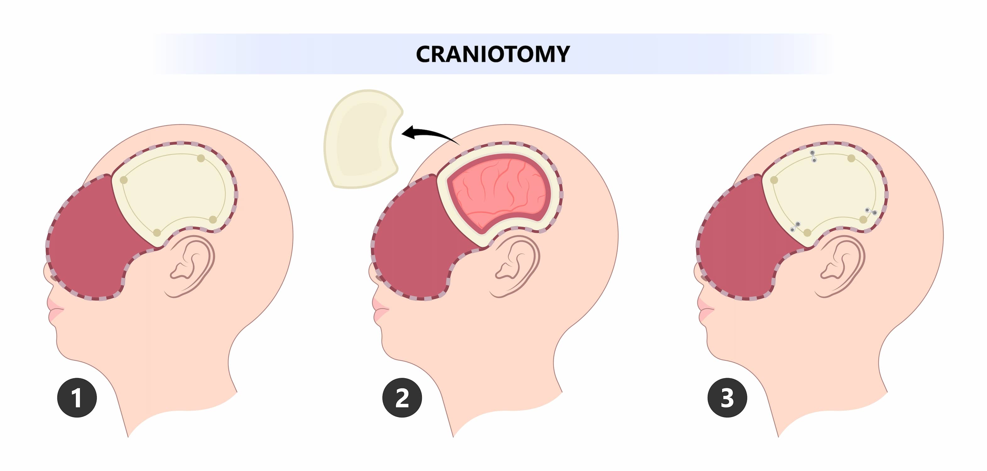 Craniotomie de turquie pour la procédure de résection d'une tumeur cérébrale