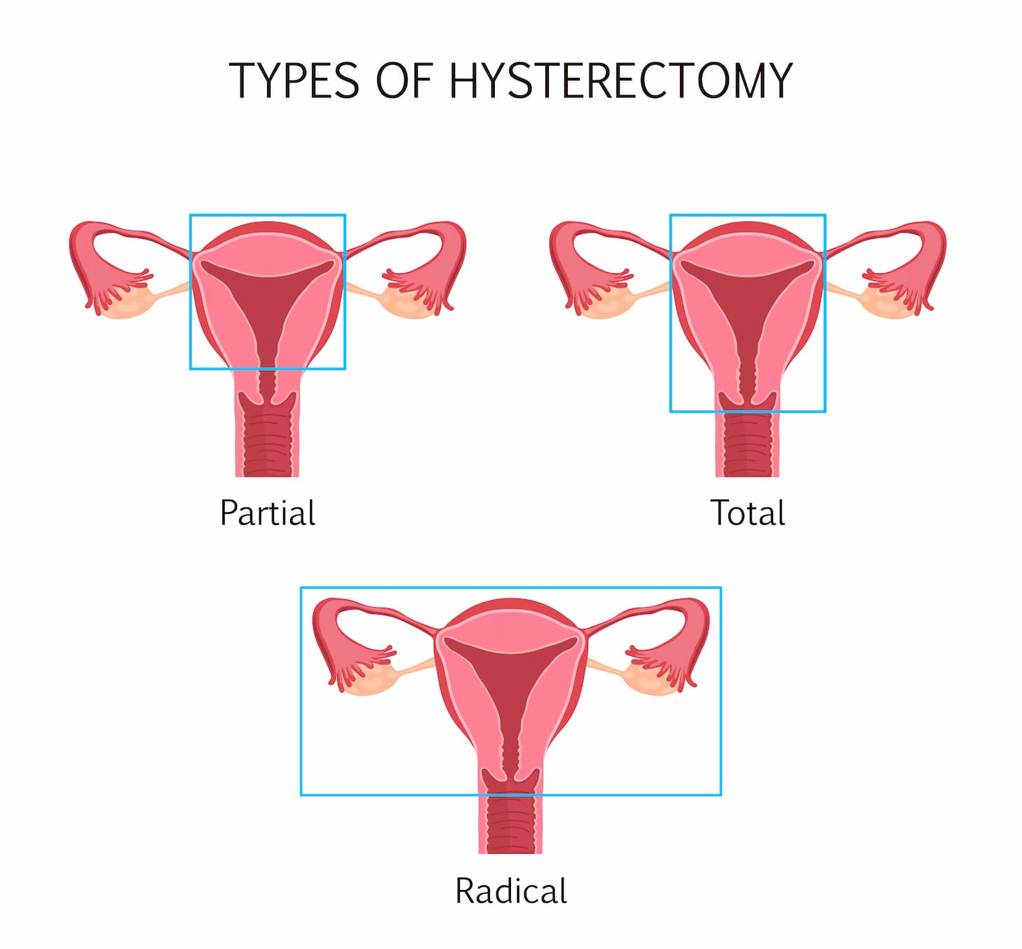 Turkey hysterectomy