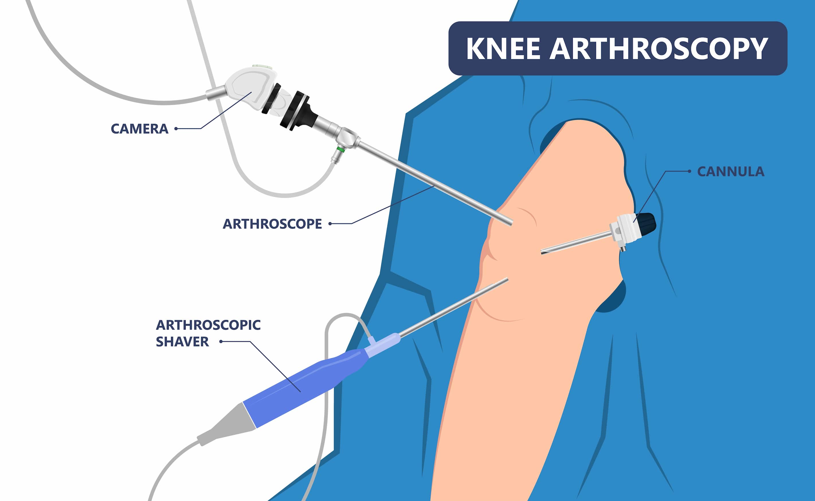 Knee arthroscopy turkiye