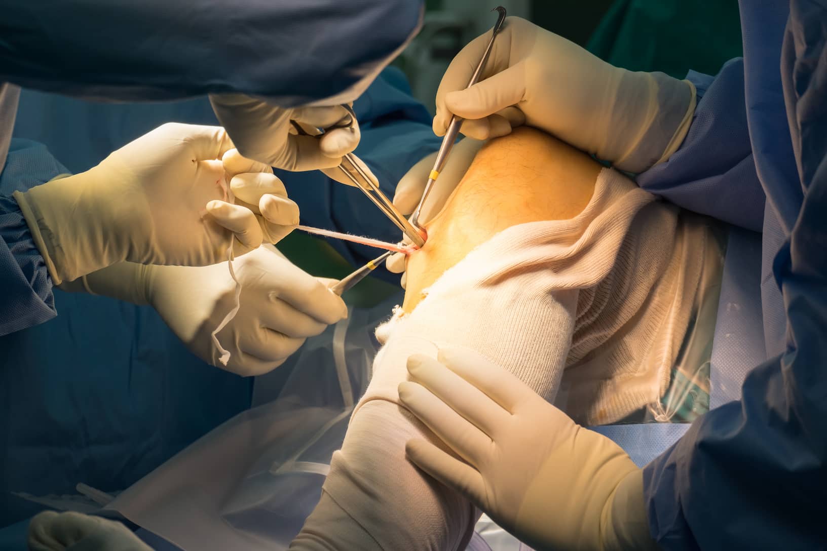 Procédure chirurgicale de méniscectomie de turquie