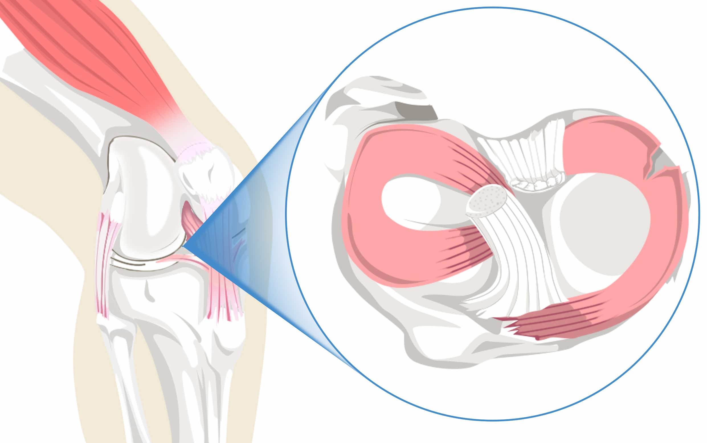 Turkiye torn meniscus treatment