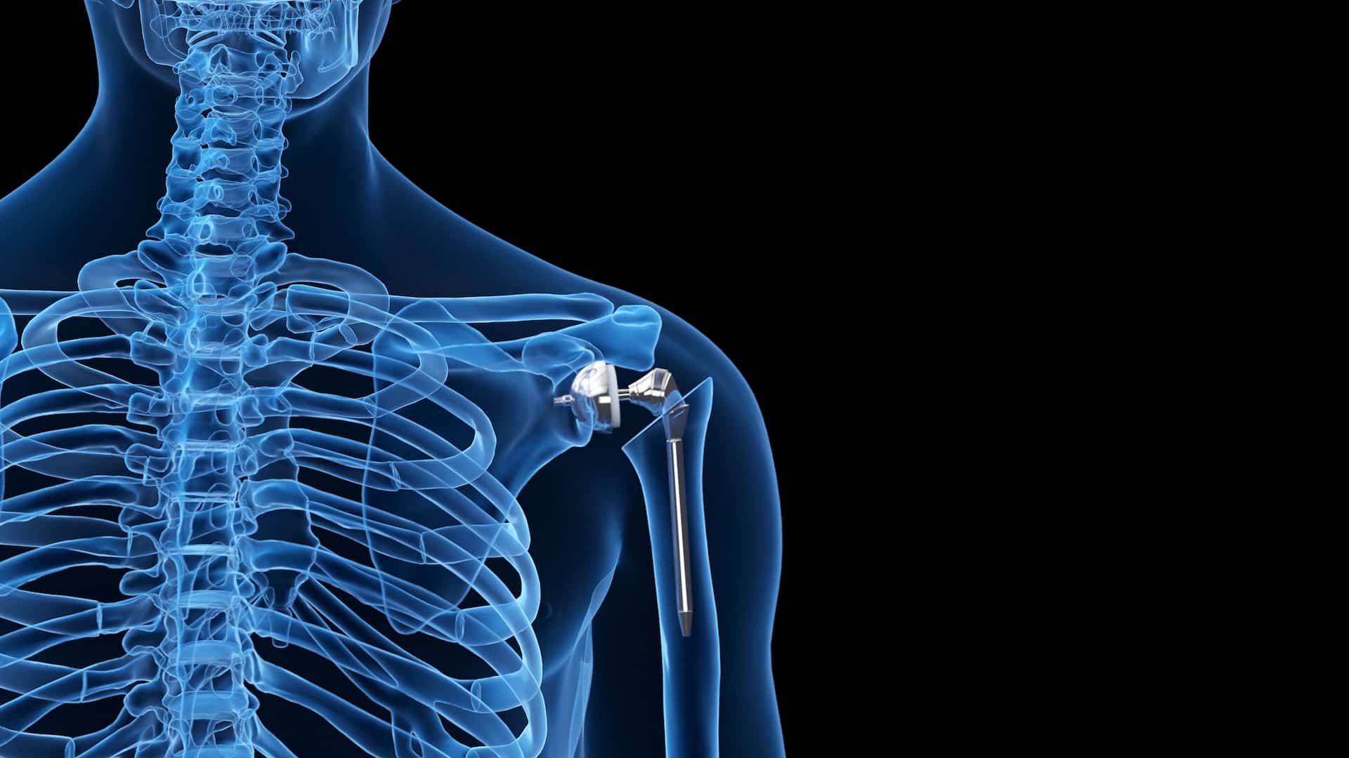 Turkiye shoulder replacement surgery