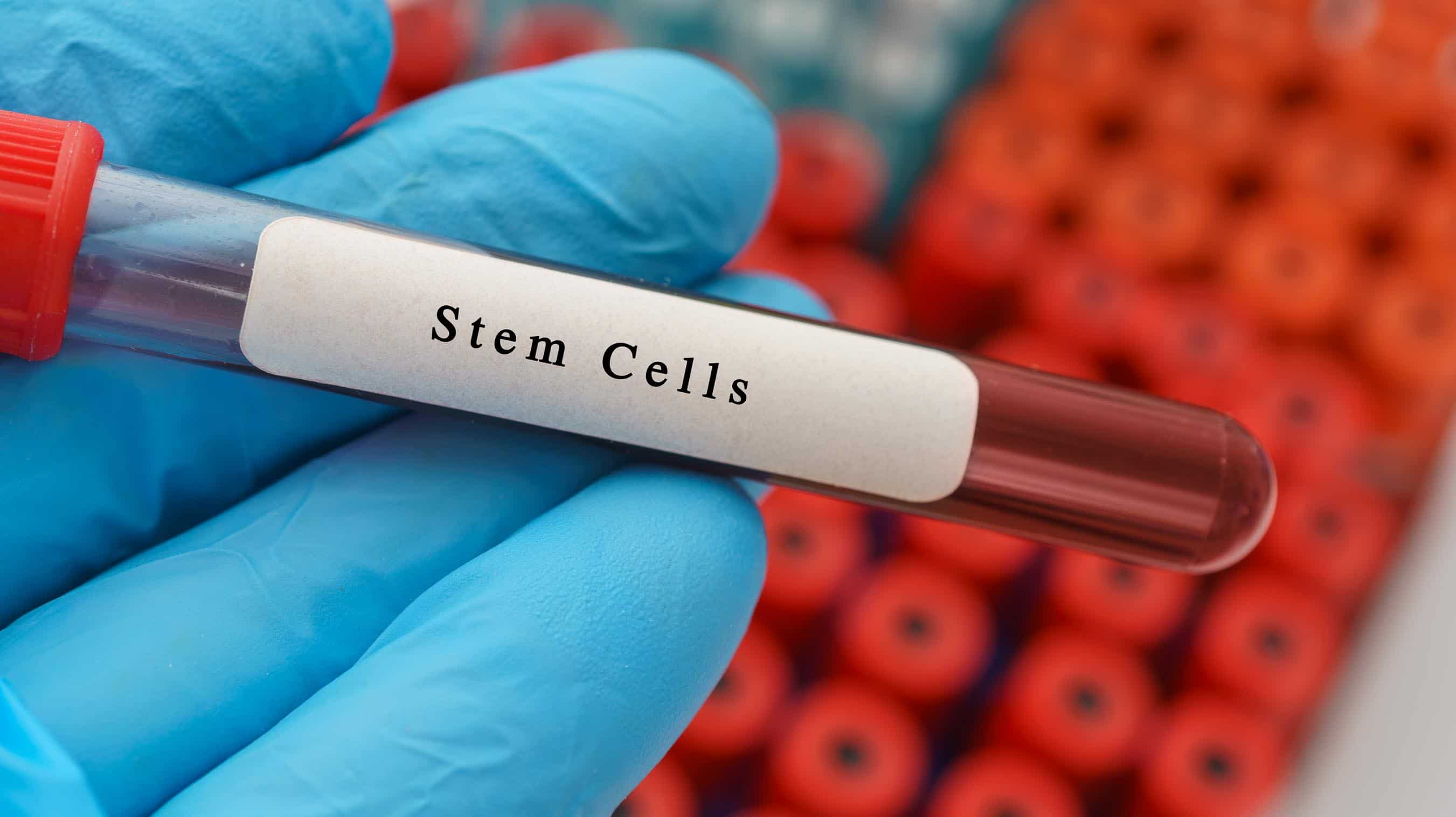 Turkey stem cell transplant for leukemia treatment