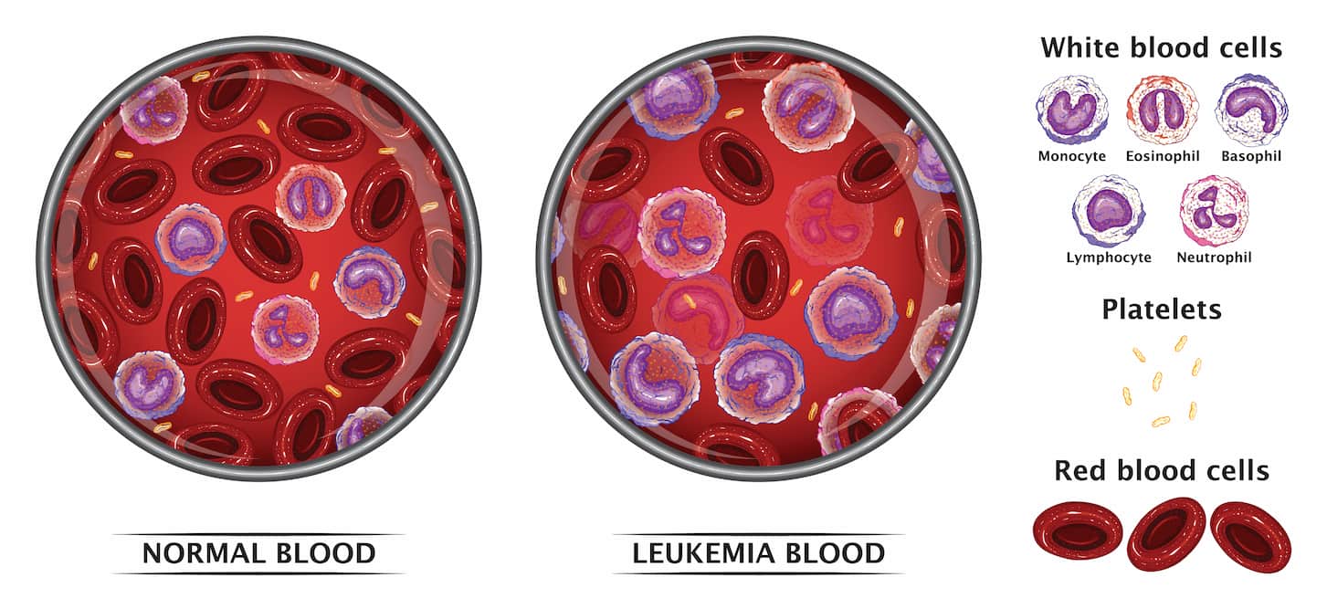 Greffe de cellules souches pour la procédure de traitement de la leucémie turquie