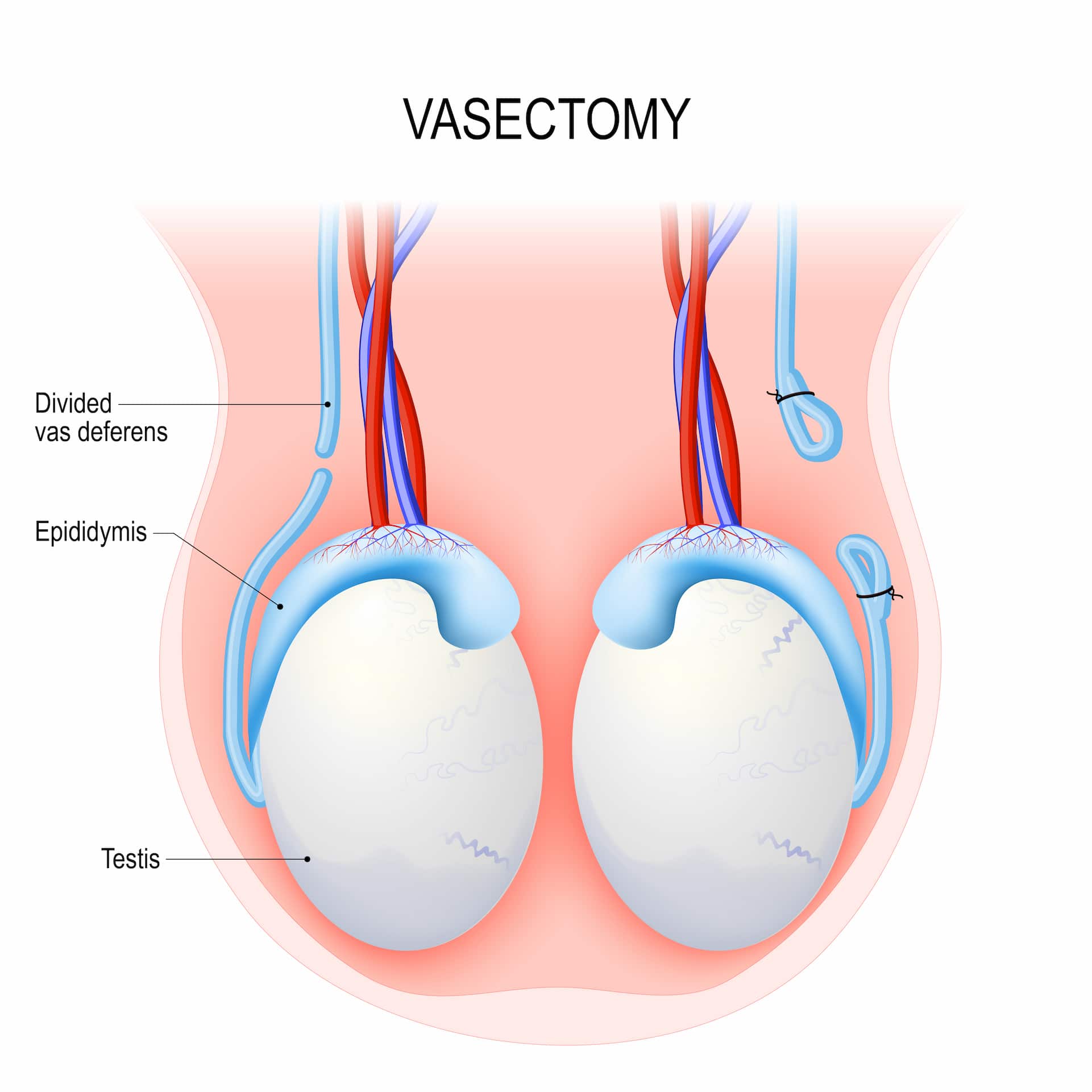 Vasectomie turque