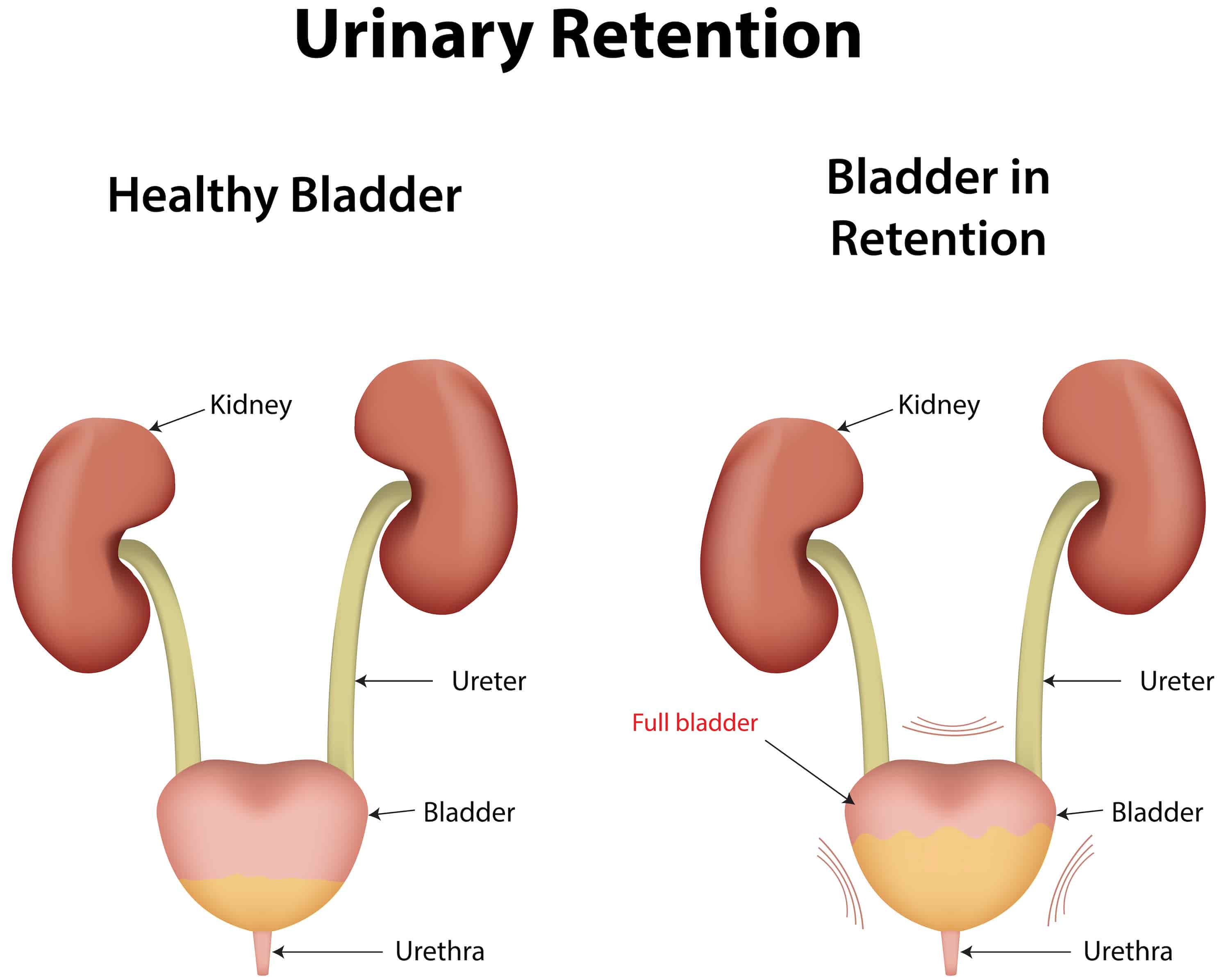 Turkiye urinary retention treatment