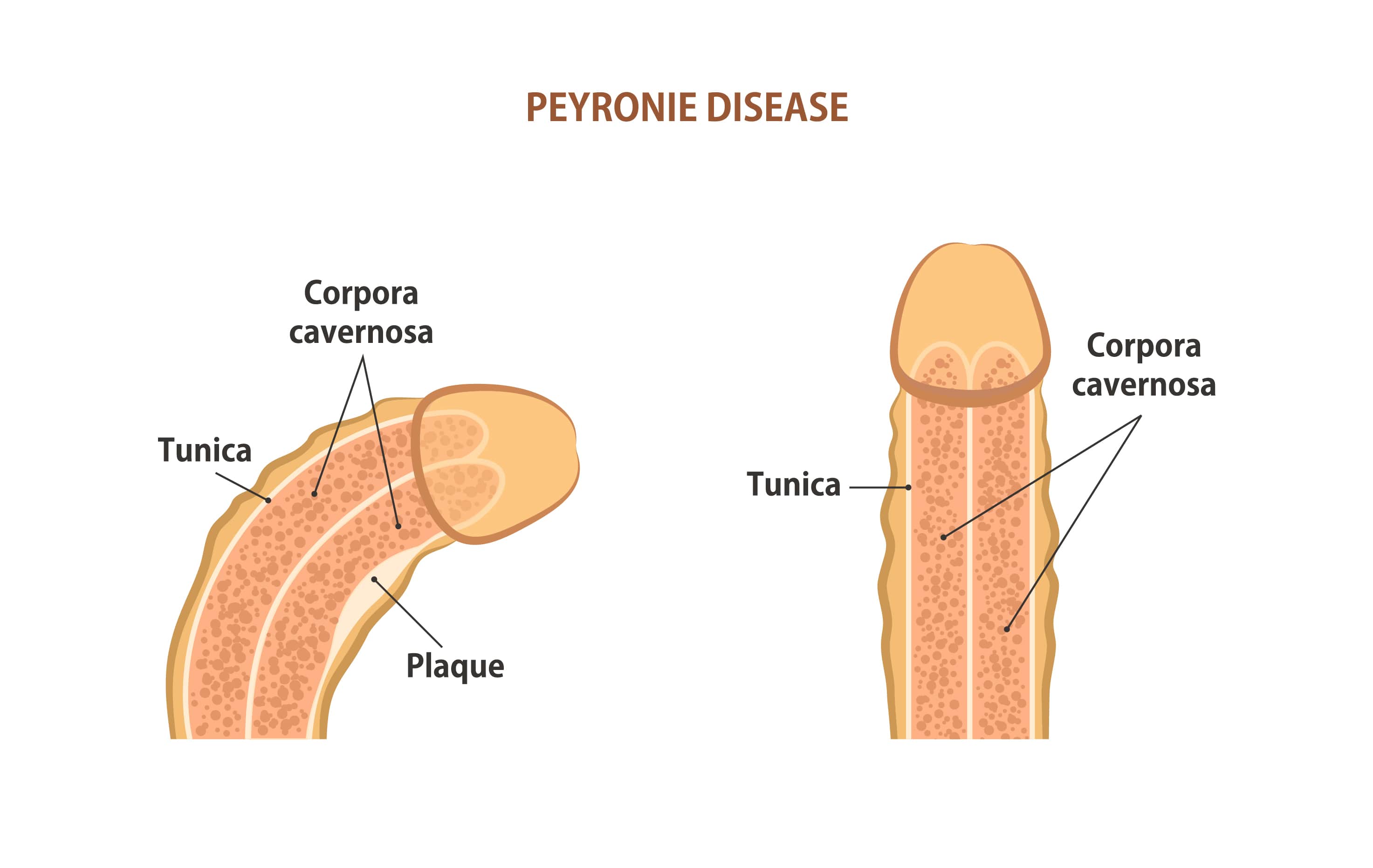 Traitement de la maladie de la peyronie turquie