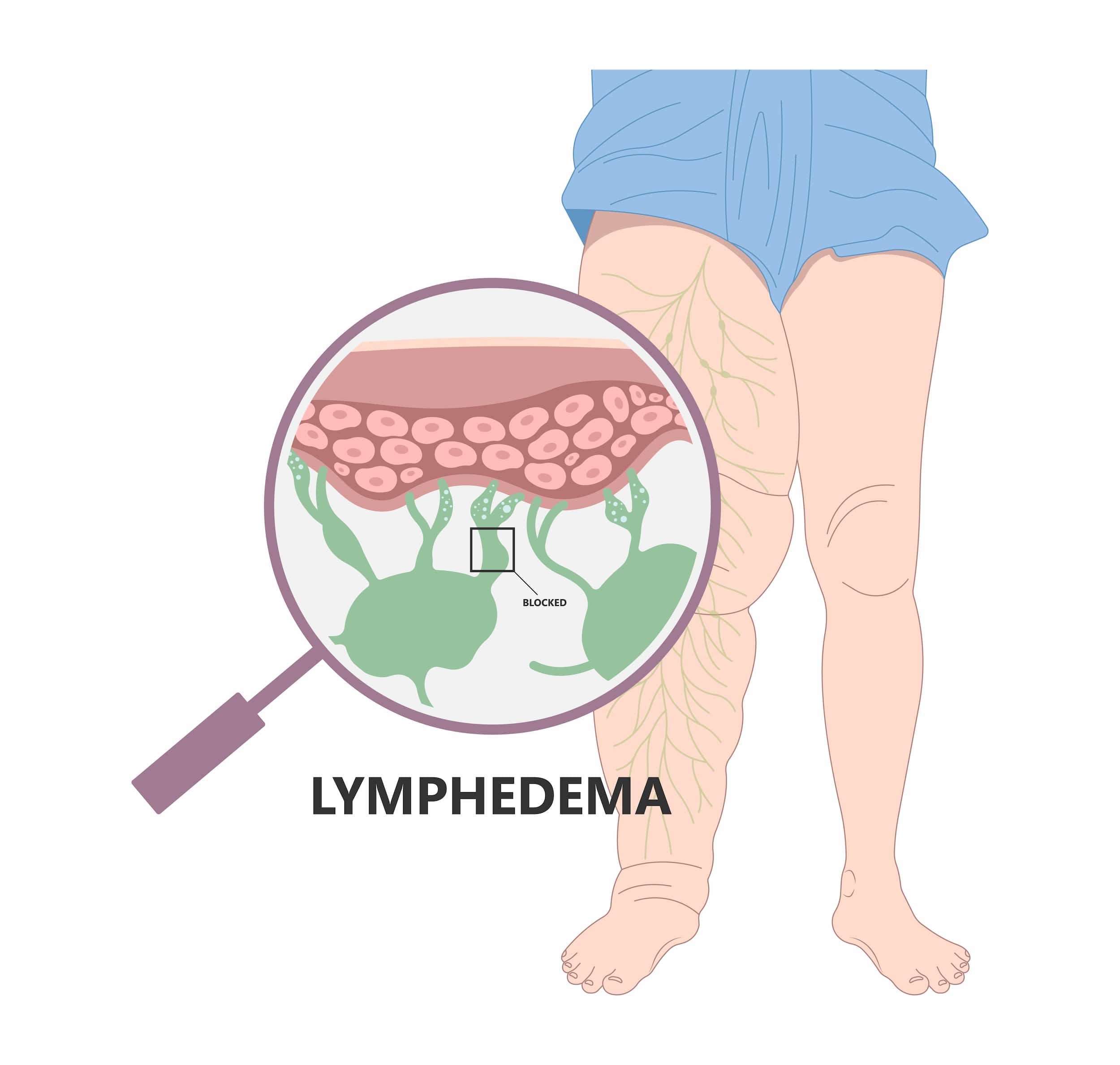 Lymphoedema treatment turkiye