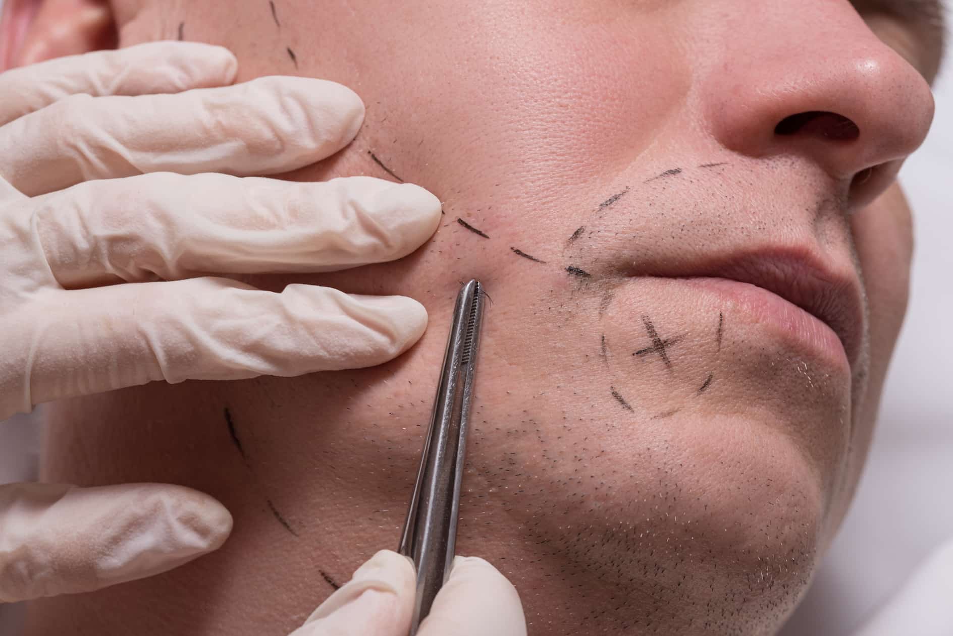 Understanding the Factors that Affect Beard Transplant Costs