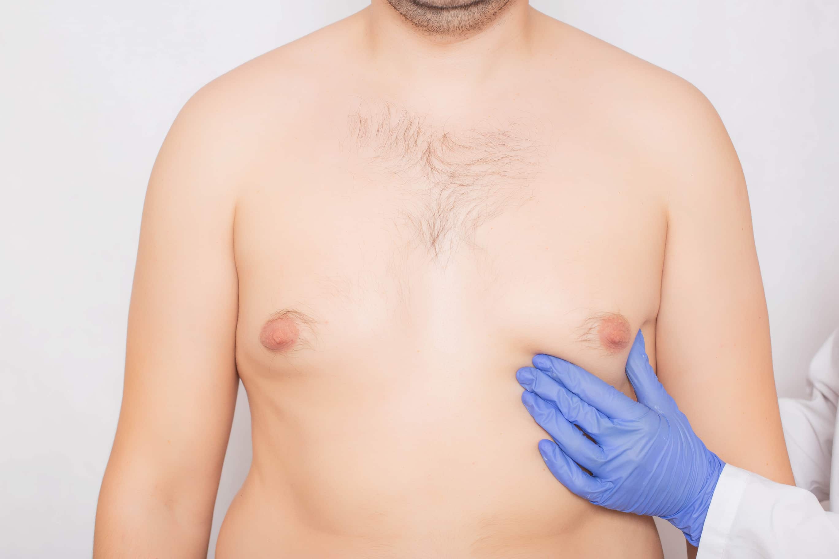 hormonal imbalances and gynecomastia how theyre connected
