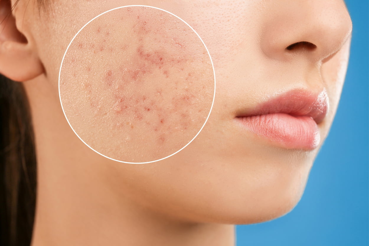 clearing the past effective acne scar treatment options