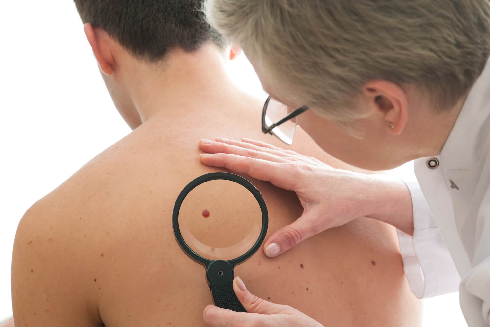melanoma or skin cancercarcinoma know the difference