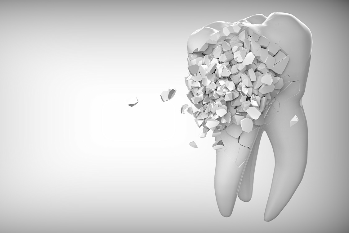 Broken Tooth, But No Pain? Here’s What To Do About It