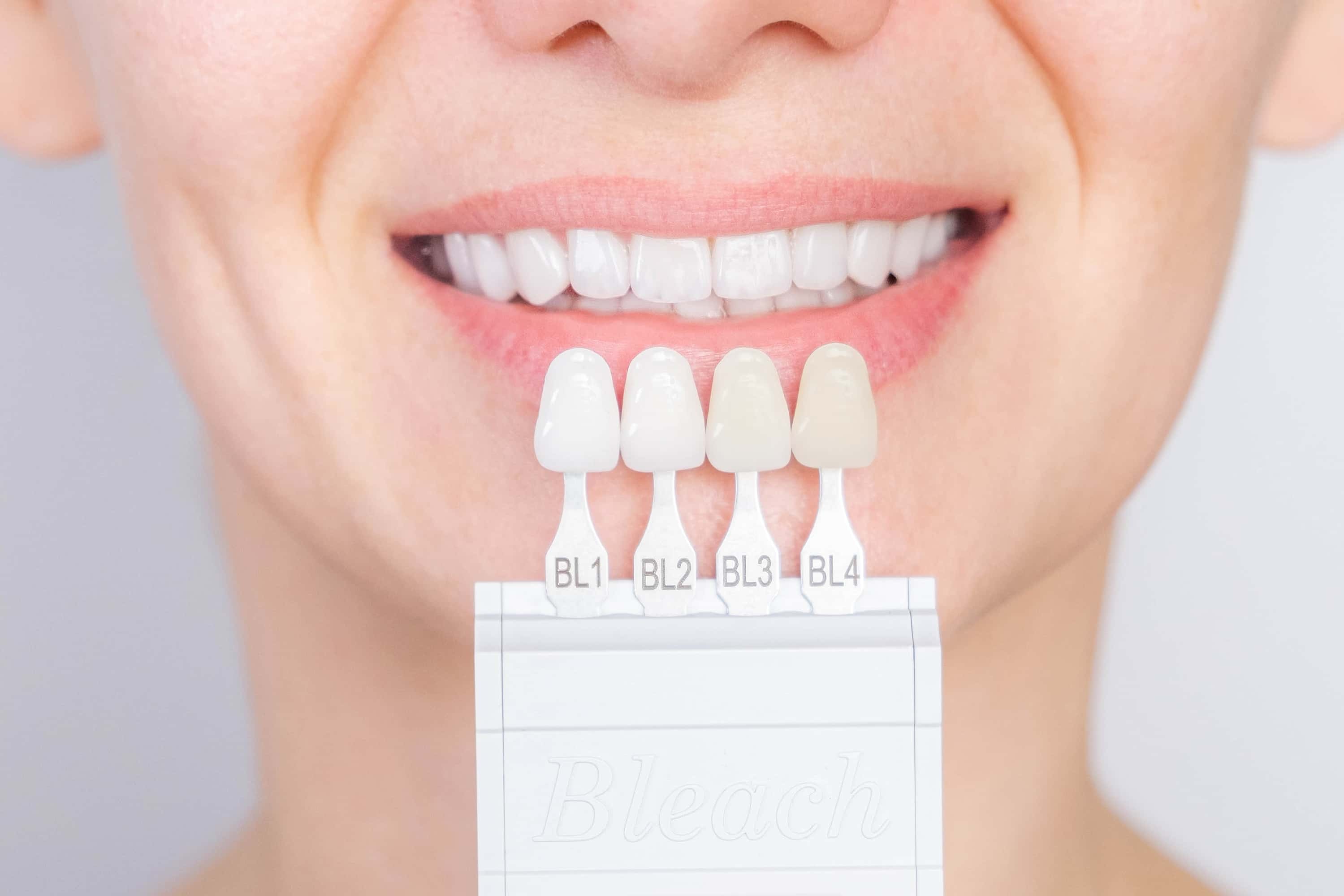 Advantages and Disadvantages of Veneers