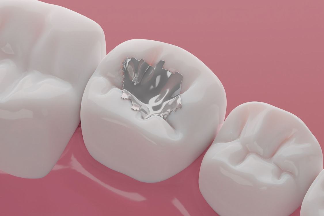 Amalgam vs. Composite Fillings: Which Is Better for Your Teeth?
