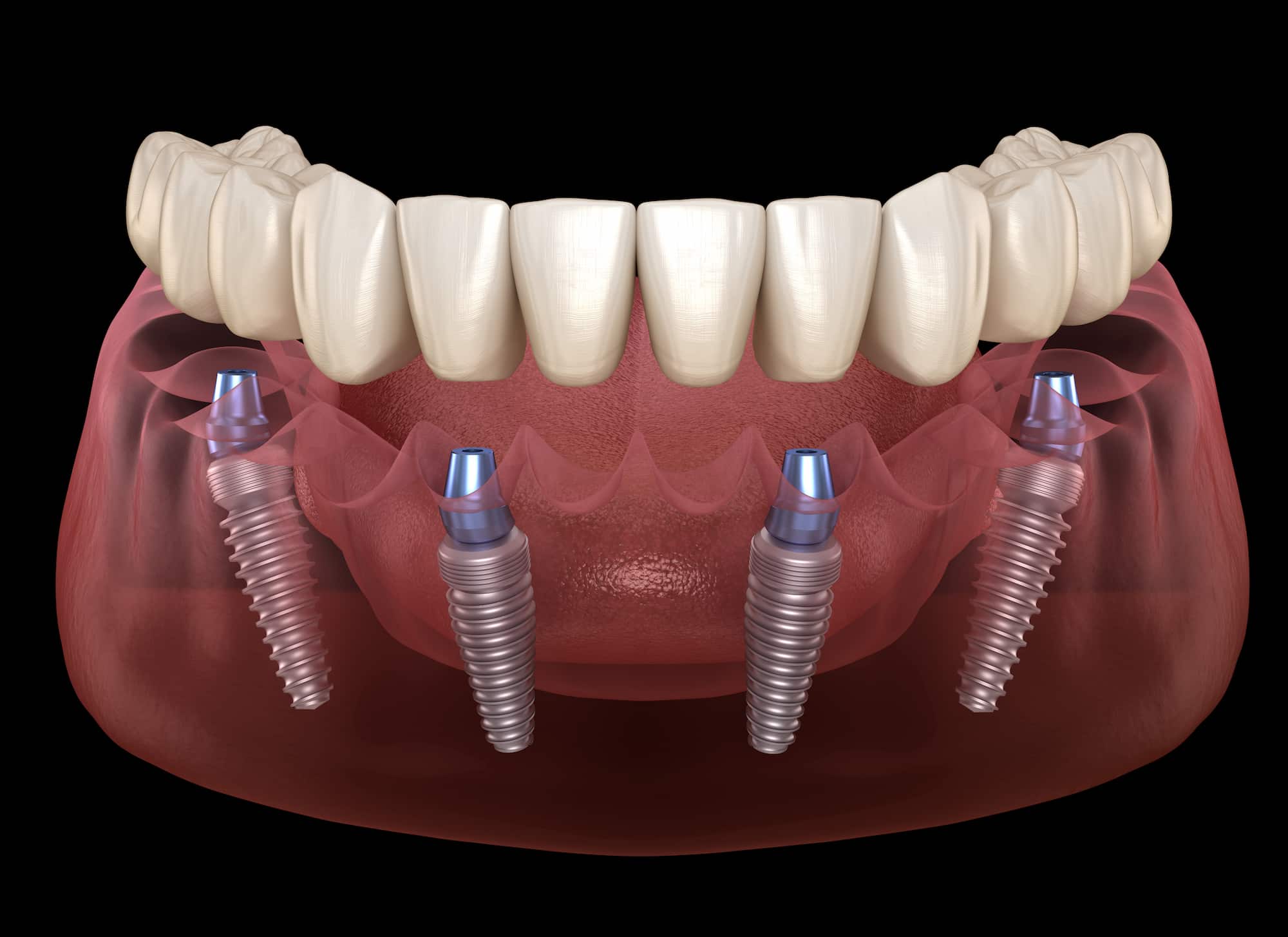 candidate for all on 4 dental implants