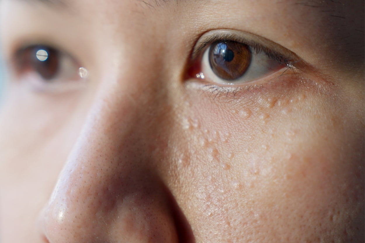 How to Get Rid of Those Annoying White Bumps Under Eyes