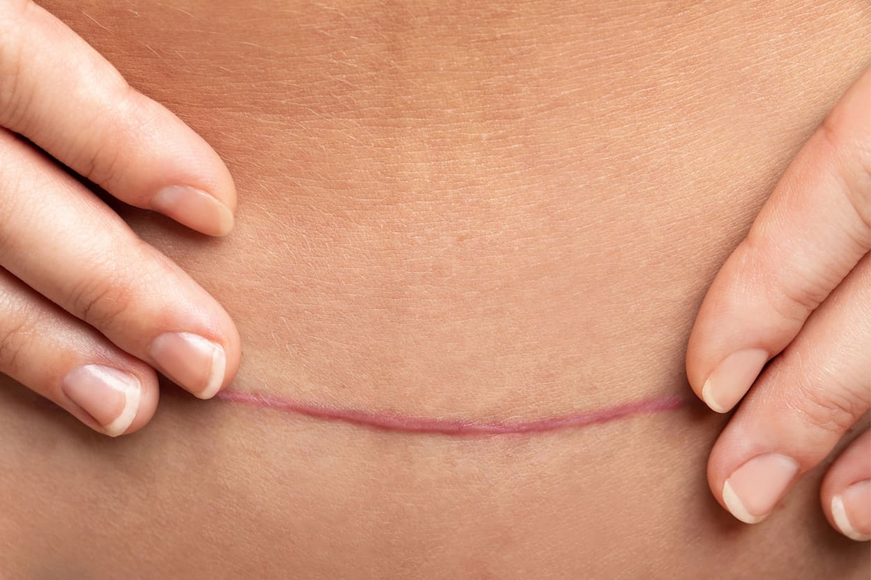 how to reduce scarring after cosmetic surgery