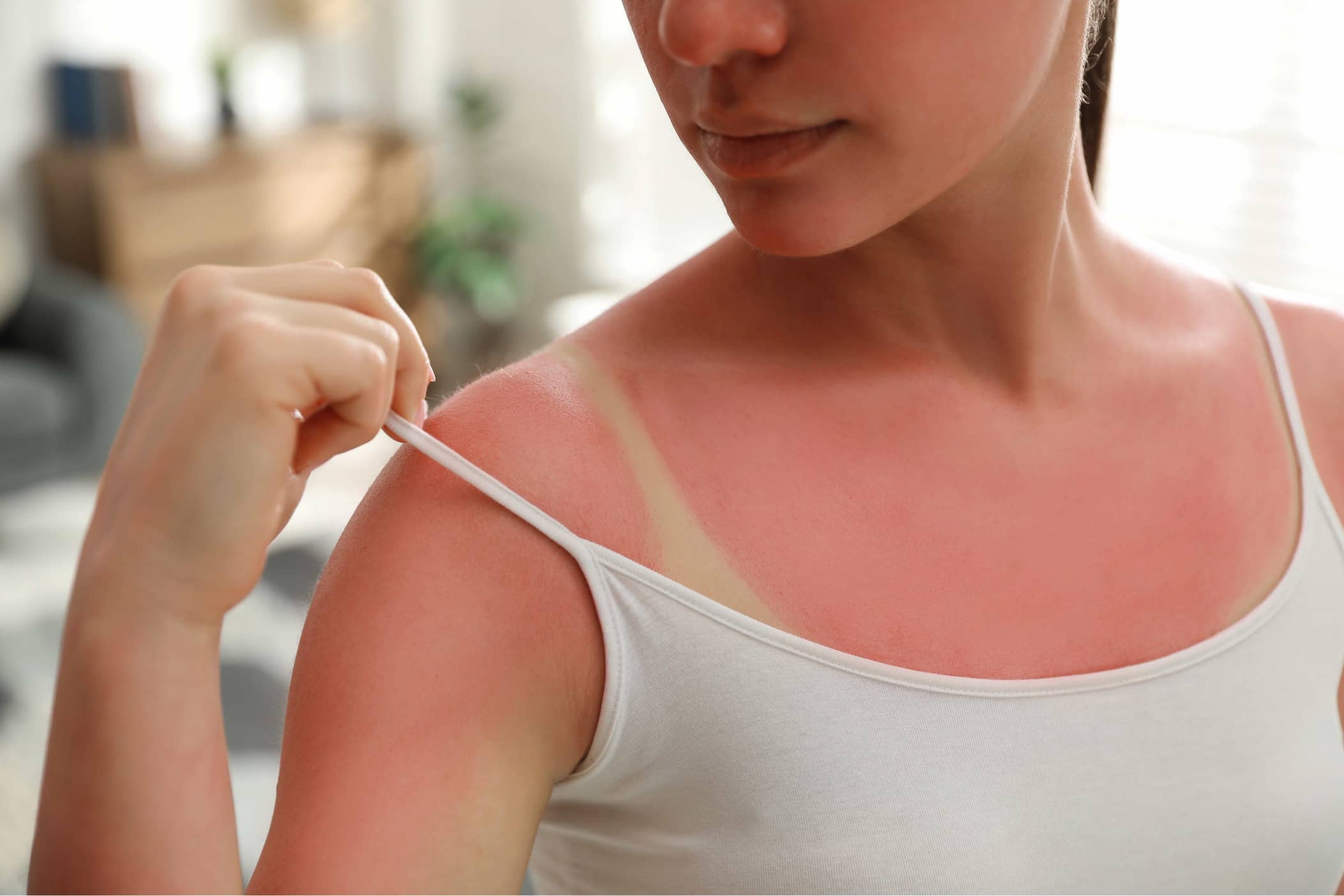 how to get rid of sunburn fast