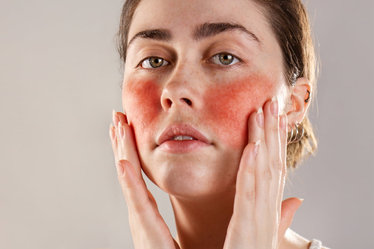 the ultimate guide to finding the best treatment for rosacea