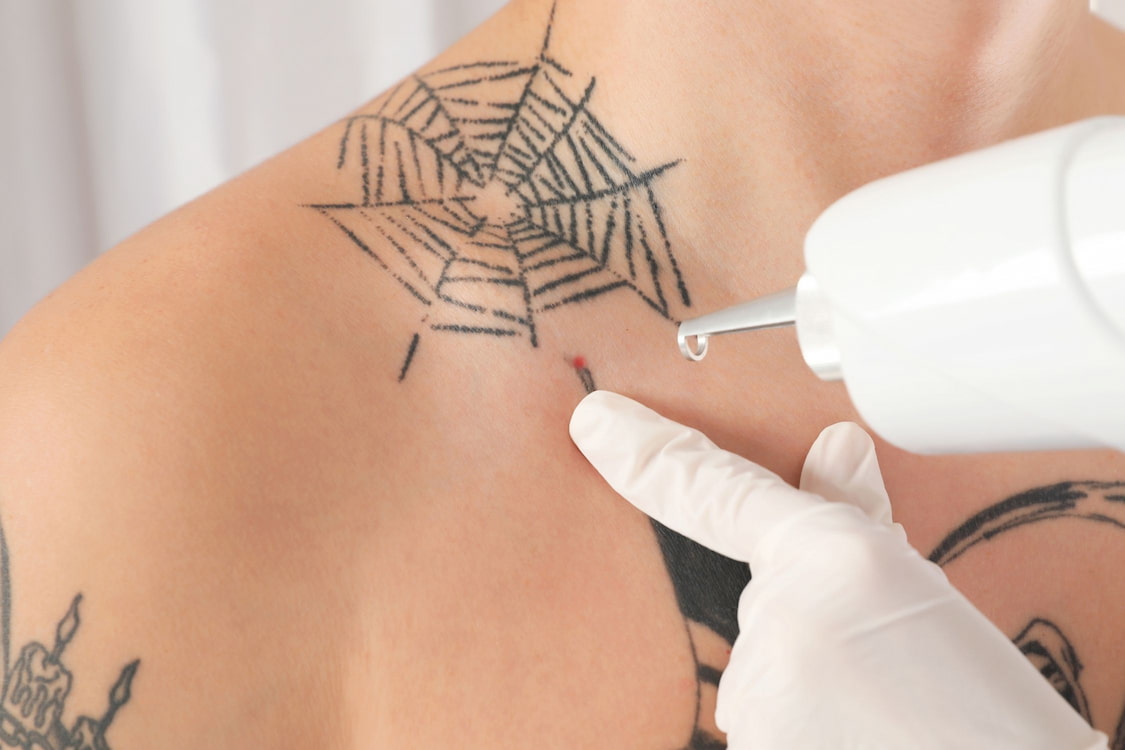 tattoo removal cost